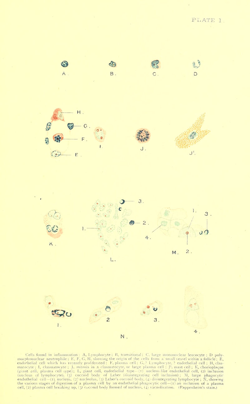 ® # € i) A . B . C. D H % ^ F. * %^ % J, J' K . % M. 2. 2 3. N . Cells found in inflammation : A, Lymphocyte; 1!, iransitior.iil; C. lari^e monoiuiclear leucocyte; D poly- morplionuclear neulrophile ; K, F, G, H, sliouinji the orij^'in of the lells from a small ves'^el wilhin a follicle; K, endothelial cell which has recently proliferated; F, plasma cell; fl, ? Lymphoryie. ? endothelial cell; H, clas- malocyte ; I, clasmatocyte ; J, mitosis in a clasmatocyte, or lar<;e pl.isma cell ; J', mast rell ; K, chorioplatjue (yianb cnll. plasma cell lype); L, giant cell, endothelial type—(i) nuclens-like endothelial cell, (2) inclusion (nucleus of lymphocyte). (3) coccoid body of Leber (disin(e}iratin<^ cell inclusion) ; M, large phagocytic endothelial cell—(i), nucleus, {2) nucleolus, (},) Leber's < oc( oid body, (4.1 dtsintegratinj> lymphocyte ; N, showing the various stages of digestion of a plasma cell by an endothelial phagocytic cell—(1) an inclusion of a plasma cell, (2) plasma cell breaking up, fj) r,ceroid bf>dy formed of nucleus, (4; vacuolisation. f Papjjenheim's stain.)