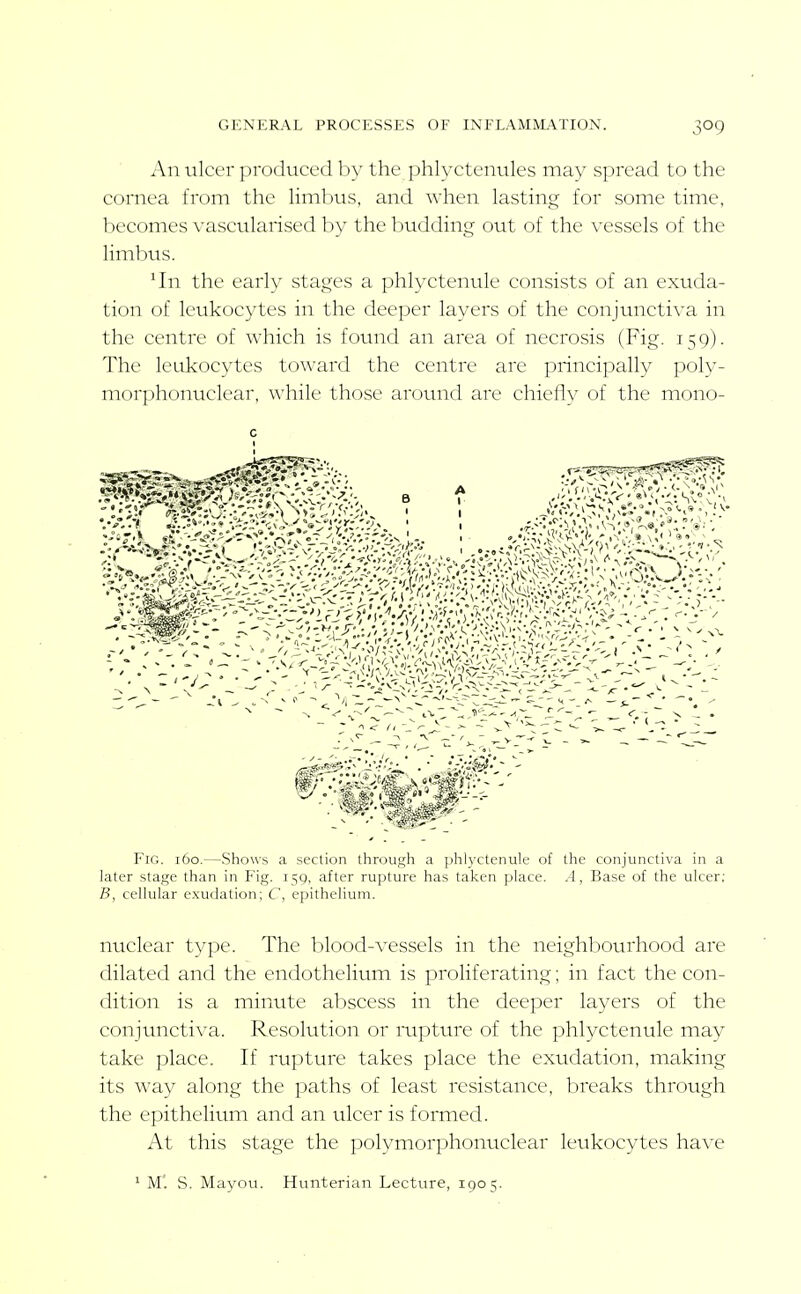 An ulcer produced by the phlyctenviles may spread to the cornea from the Hmbus, and when lasting for some time, becomes \'ascularised by the budding out of the vessels of the limbus. 'In the early stages a phlyctenule consists of an exuda- tion of leukocytes in the deeper layers of the conjunctiva in the centre of which is found an area of necrosis (Fig. 159). The leukocytes toward the centre are principally poly- morphonuclear, while those around are chieflv of the mono- FiG. 160.—Shows a section through a phlyctenule of the conjunctiva in a later stage than in Fig. 159, after rupture has taken place. A, Base of the ulcer; B, cellular exudation; C, epithelium. nuclear type. The blood-vessels in the neighbourhood are dilated and the endothelium is proliferating; in fact the con- dition is a minute abscess in the deeper layers of the conjunctiva. Resolution or mpture of the phlyctenule may take place. If rupture takes place the exudation, making its way along the paths of least resistance, bi^eaks through the epithelium and an ulcer is formed. At this stage the polymorphonuclear leukocytes have c