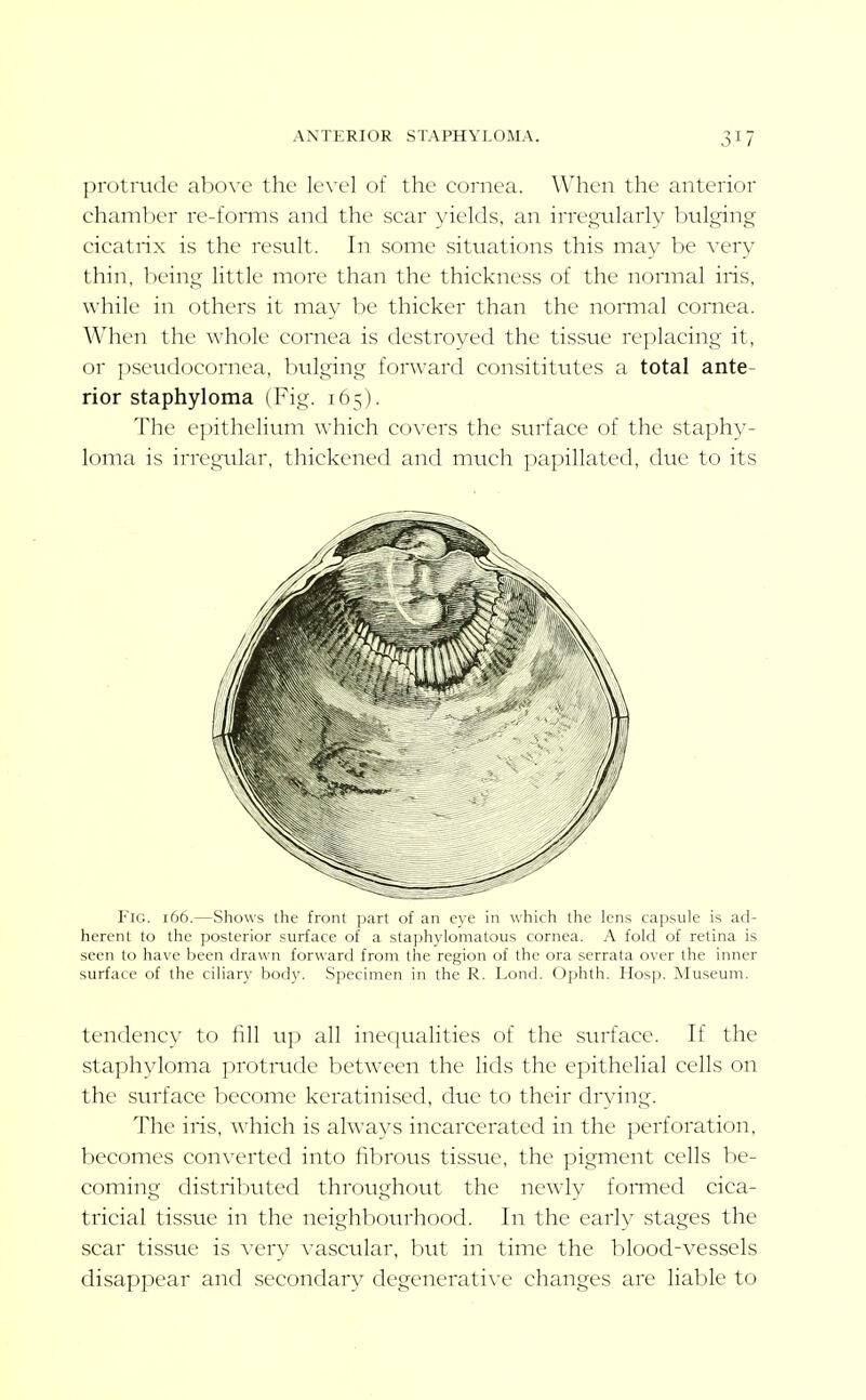 ANTERIOR STAPHYLOMA. protrude above the level of the cornea. When the anterior chanil)er re-fomis and the scar yields, an irregularly bulging cicatrix is the result. In some situations this may be very thin, being little more than the thickness of the nonnal iris, while in others it may be thicker than the nomial comea. When the whole cornea is destroyed the tissue re])lacing it, or pseudocornea, bulging forward consititutes a total ante- rior staphyloma (Fig. 165). The epithelium which covers the surface of the staphy- loma is irregular, thickened and much papillated, due to its Flc. 166.—Shows the front part of an eye in which the lens capsule is ad- herent to the posterior surface of a staphylomatous cornea. A fold of retina is seen to have been drawn forward from the region of the ora serrata over the inner surface of the ciHary body. Specimen in the R. Lond. Ophth, Hosp. Museum. tendency to fill u]) all inequalities of the surface. If the staphyloma protrude between the lids the epithelial cells on the siud'ace become keratinised, due to their drying. The iris, which is always incarcerated in the perforation, becomes converted into fibrous tissue, the pigment cells be- coming distributed throughout the newly formed cica- tricial tissue in the neighbourhood. In the early stages the scar tissue is very vascular, but in time the blood-vessels disappear and secondary degenerative changes are liable to
