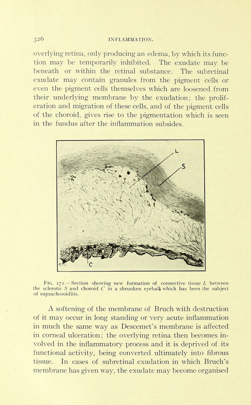 overlying retina, only producing an edema, by which its func- tion may be temporarily inhibited. The exudate may be beneath or within the retinal substance. The subretinal exudate may contain granules from the pigment cells or even the pigment cells themselves which are loosened from their underlying membrane by the exudation; the prolif- eration and migration of these cells, and of the pigment cells of the choroid, gives rise to the pigmentation which is seen in the fundus after the inflammation subsides. Fig. 171.—Section showing new formation of connective tissue L between the sclerotic 5 and choroid C in a shrunken eyeball which has been the subject of suprachoroiditis. A softening of the membrane of Bruch with destruction of it may occur in long standing or Very acute inflammation in much the same way as Descemet's membrane is affected in corneal ulceration; the overlying retina then becomes in- volved in the inflammatory process and it is deprived of its functional activity, being converted ultimately into fibrous tissue. In cases of subretinal exudation in which Bruch's membrane has given way, the exudate may become organised