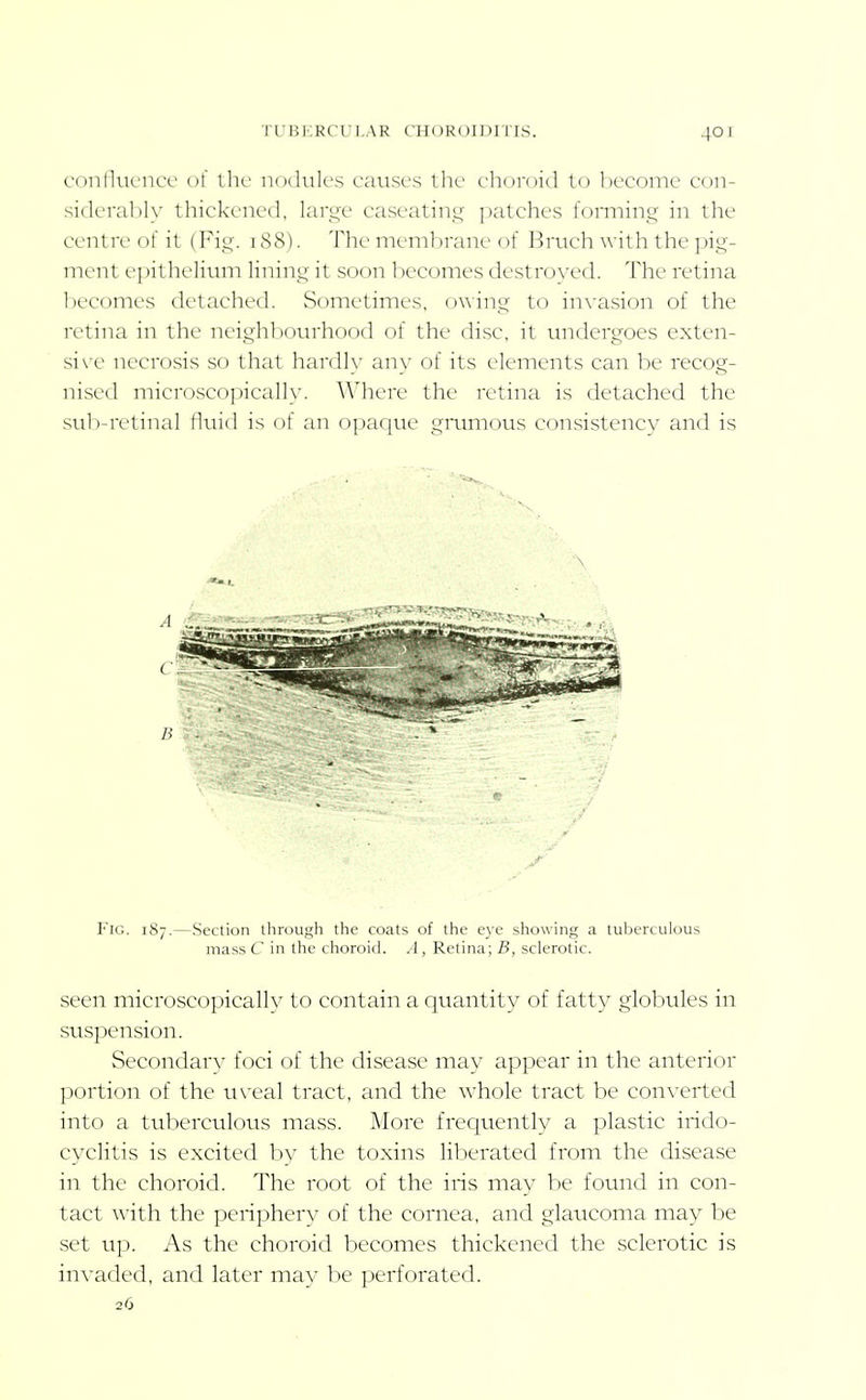 confluence of the nodules causes the choroid to become con- siderably thickened, lari^e caseatint^^ l)atches forming in the centre of it (Fig. i8cS). The membrane of Bruch with the pig- nu'nt e])illK'Iium lining it soon I )ecomes destroyed. The retina becomes detaclu'd. Sometimes, owing to in\-asion of the retina in the neighbourhood of the disc, it undergoes exten- si\-e necrosis so that hardly any of its elements can be recog- nised microscopically. AVhere the retina is detached the sul)-retinal fluid is of an o])ar|ue gnmious consistency and is Fig. 187.—Section through the coats of the eye showing a tuberculous mass C in the choroid. .^1, Retina; B, sclerotic. seen microscopical!}' to contain a quantity of fatty globules in suspension. Secondary foci of the disease may appear in the anterior portion of the uveal tract, and the whole tract be converted into a tuberculous mass. More frequently a plastic irido- cyclitis is excited bv the toxins liberated from the disease in the choroid. The root of the iris may be found in con- tact with the periphery of the cornea, and glaucoma may be set up. As the choroid becomes thickened the sclerotic is invaded, and later may he perforated. 26