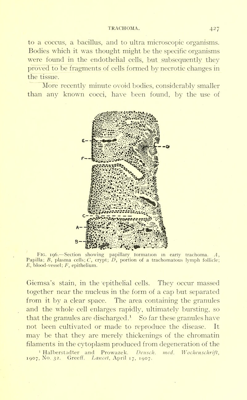 to a coccus, a bacillus, and to ultra microscopic organisms. Bodies which it was thought might be the specific organisms were found in the endothelial cells, but subseqtiently they proved to be fragments of cells fonned by necrotic changes in the tissue. ^lore recently minute o\-oid bodies, considerably smaller than any known cocci, ha\'e been found, by the use of Fig. 196.—Section showing papillary lormation in early trachoma. A, Papilla; B, plasma cells; C, crypt; D, portion of a trachomatous lymph follicle; E, blood-vessel; F, ei)ithelium. Gicmsa's stain, in the ■ej.nthelial cells. They occur massed together near the nucleus in the form of a cap but separated from it by a clear space. The area containing the granules and the whole cell enlarges rapidly, ultimately bursting, so that the granules are discharged.' So far these granules have not been cultivated or made to reproduce the disease. It may be that they are merely thickenings of the chromatin filaments in the cytoplasm produced from degeneration of the ' Halberstadter and Prowazek. Deiiscli. uicd. Wochcnsclirift, 1907, No. 32. Greeff. Lancet, April 17, 1907.