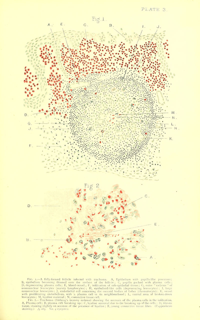 PLATE 3 Fitf 2 D. — t 1. K1 B. -V- i. Fk;. I.—A fLiIIy-fornied follicle infected with irathuina. A, Epiiheliuin with papilla-liUe processes; B, e^aitlieliurn beromitiii thinned over the surface of the foHif ie ; C, papilla packed with plasma cells ; D, degenerating plasma cells; R, blood-vessel ; K, infiltiation of sub-epithelial tissue; G, outer  radznne  of mononuclear leucocytes (mainly lymphocytes) ; H, epitheIioid-!ike cells {degencralini; leucocytes} ; I, lars^e mononuclear leucocytes; J, endothelial cell containini; the coctoid bodies of Leber (clasniatocytc) ; K, vessel with proliferatuiff endothelium, with a plasma cell in its neighbourhood; L, central area of broken-down leucocytes; M, hyaline material ; N, connective tissue cell. Fir.. 2.—Trachoma (Stelwaj^'s brawny cedema) showing ihc necrosis of the plasma cells in the infiltration. A, Plasma cell; B, plasma cell breaking up ; C, hyaline material due to the breaking up of the cells ; I), I'lbmus tissue, staining slightly on account nf the presence of hyaline ; E, young connective tissue fibre- (I'appenliemi staining.) -^-n obj. No. i| eyepiece.