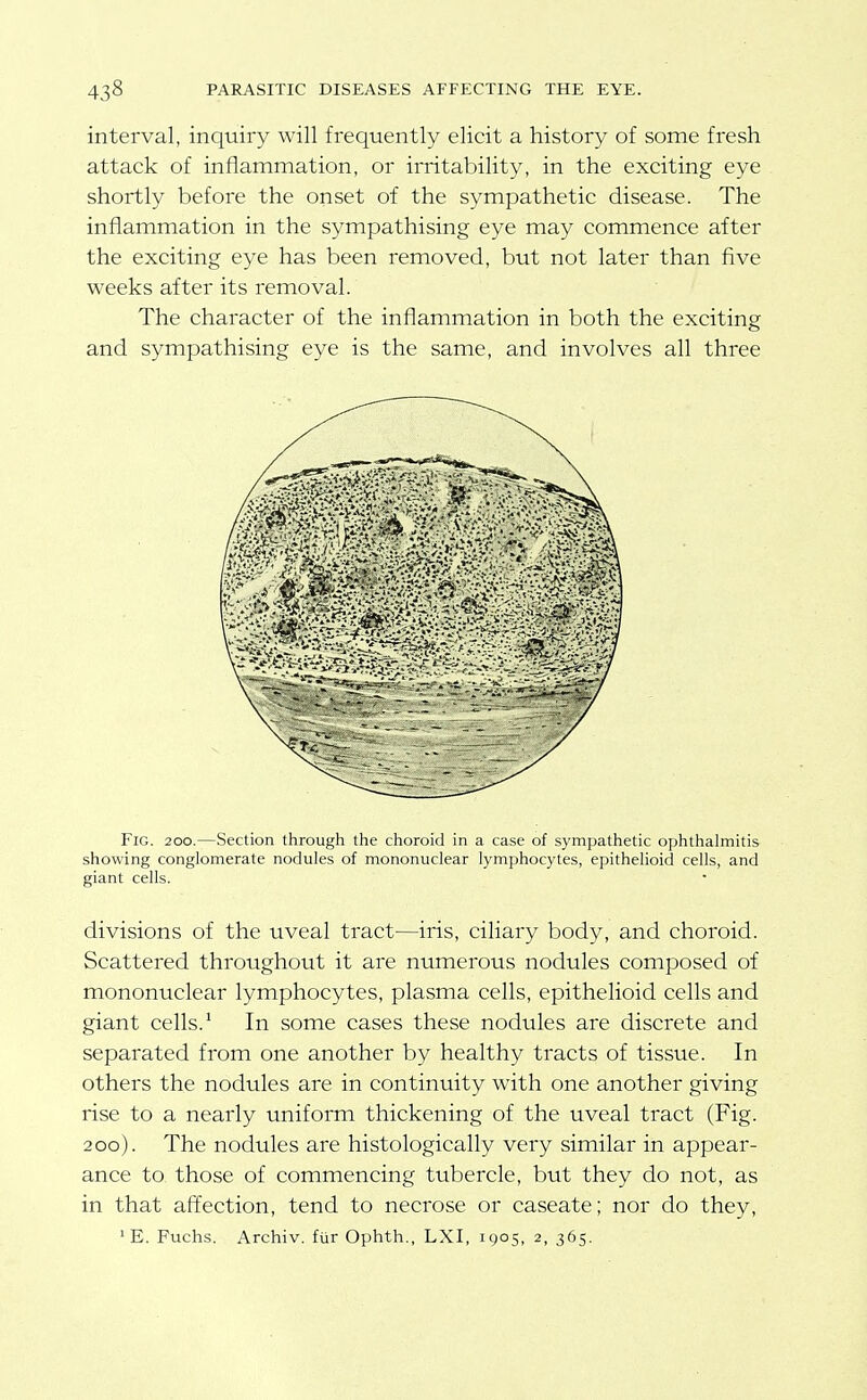 interval, inquiry will frequently elicit a history of some fresh attack of inflammation, or irritability, in the exciting eye shortly before the onset of the sympathetic disease. The inflammation in the sympathising eye may commence after the exciting eye has been removed, but not later than five weeks after its removal. The character of the inflammation in both the exciting and sympathising eye is the same, and involves all three Fig. 200.—Section through the choroid in a case of sympathetic ophthalmitis showing conglomerate nodules of mononuclear lymphocytes, epithelioid cells, and giant cells. divisions of the uveal tract—iris, ciliary body, and choroid. Scattered throughout it are numerous nodules composed of mononuclear lymphocytes, plasma cells, epithelioid cells and giant cells. ^ In some cases these nodules are discrete and separated from one another by healthy tracts of tissue. In others the nodules are in continuity with one another giving rise to a nearly uniform thickening of the uveal tract (Fig. 200). The nodules are histologically very similar in appear- ance to those of commencing tubercle, but they do not, as in that affection, tend to necrose or caseate; nor do they, ' E. Fuchs. Archiv. fur Ophth., LXI, 1905, 2, 365.