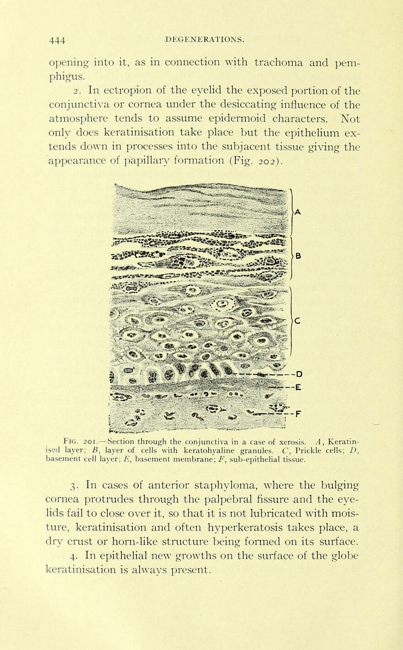 opening into it, as in connection with trachoma and pem- phigus. 2. In ectropion of the eyelid the exposed portion of the conjunctiva or cornea under the desiccating influence of the atmosphere tends to assume epidei-moid characters. Not only does keratinisation take place but the epithelium ex- tends down in processes into the subjacent tissue giving the appearance of papillary formation (Fig. 202). Fig. 201.—Section through the conjunctiva in a case of xerosis. A, Keratin- ised layer; B, layer of cells with keratohyaline granules. C, Prickle cells; D, basement cell layer; £, basement membrane; sub-epithelial ti.ssue. 3. In cases of anterior staphyloma, where the bulging cornea protrudes through the palpebral fissure and the eye- lids fail to close over it, so that it is not lubricated with mois- ture, keratinisation and often hyperkeratosis takes place, a dry crust or horn-like structure being formed on its surface. 4. In epithelial new growths on the surface of the globe keratinisation is always present.