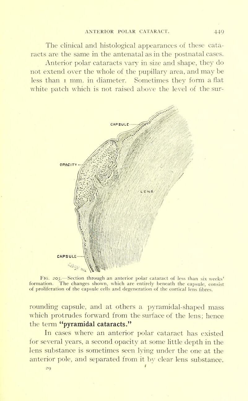 The clinical and histological appearances of these cata- racts are the same in the antenatal as in the postnatal cases. Anterior polar cataracts vary in size and shape, they do not extend over the whole of the pupillary area, and may be less than i mm. in diameter. Sometimes they form aflat white patch which is not raised abox'c the le\'el of the sur- FiG. 203.—Section through an anterior polar cataract of less than six weeks' formation. The changes shown, which are entirely beneath the ca])sule, consist of [jroliferation of the capsule cells and degeneration of the cortical lens fibres. rounding capsule, and at others a pyramidal-shaj;)ed mass which ])rotrudes fonvard from the surface of the lens; hence the term pyramidal cataracts. In cases where an anterior polar cataract has existed for several years, a second opacity at some little depth in the lens substance is sometimes seen Iving under the one at the anterior pole, and separated from it by clear lens substance.