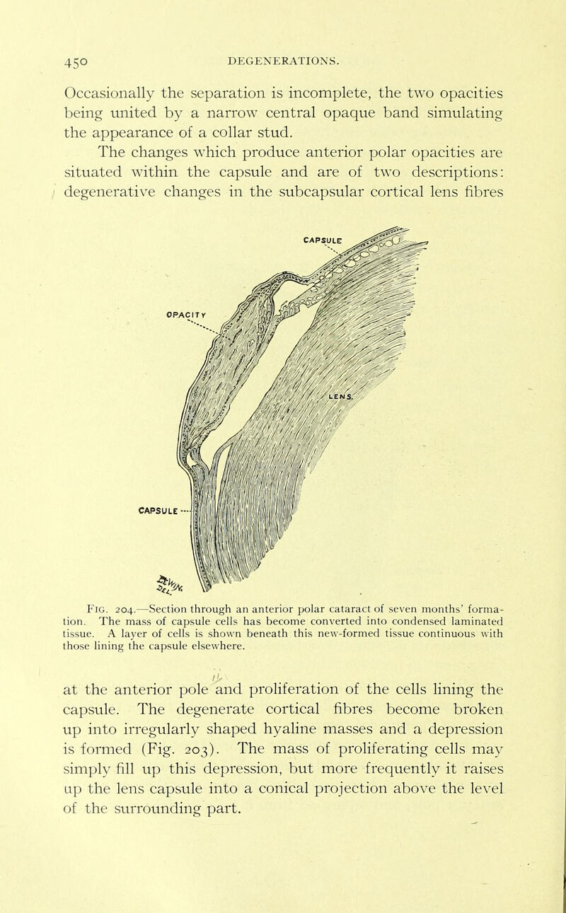 Occasionally the separation is incomplete, the two opacities being united by a narrow central opaque band simulating the appearance of a collar stud. The changes which produce anterior polar opacities are situated within the capsule and are of two descriptions: degenerative changes in the subcapsular cortical lens fibres Fig. 204.—Section through an anterior polar cataract of seven months' forma- tion. The mass of capsule cells has become converted into condensed laminated tissue. A layer of cells is shown beneath this new-formed tissue continuous with those lining the capsule elsewhere. at the anterior pole and proliferation of the cells lining the capsule. The degenerate cortical fibres become broken up into irregularly shaped hyaline masses and a depression is formed (Fig. 203). The mass of proHferating cells may simply fill up this depression, but more frequently it raises up the lens capsule into a conical projection above the level of the surrounding part.