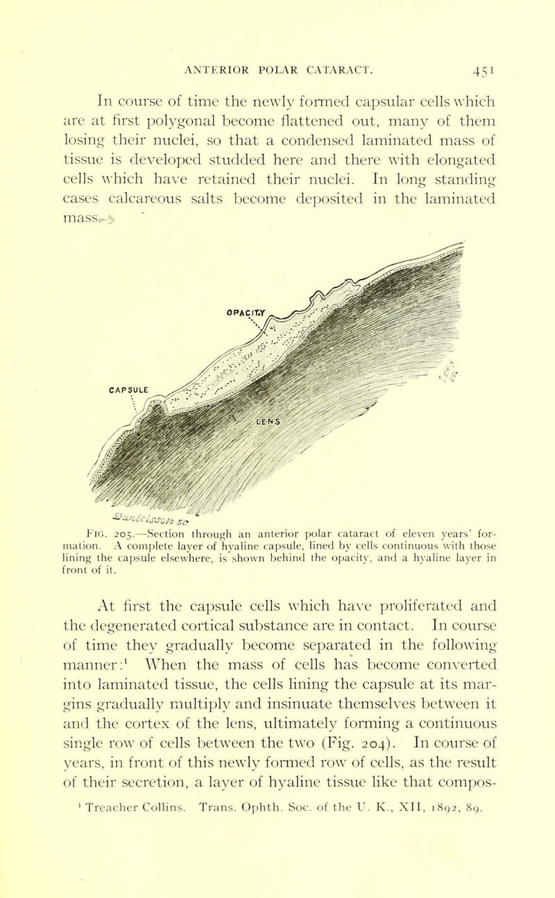 In course of time the newly formed capsular cells which are at first polygonal become flattened out, many of them losing their nuclei, so that a condensed laminated mass of tissue is developed studded here and there with elongated cells ^^•hich have retained their nuclei. In long standing cases calcareous salts become deposited in the laminated mass^> Fig. 205.—Section through an anterior polar cataract of eleven years' for- mation. A complete layer of hyaline capsule, lined by cells continuous with those lining the capsule elsewhere, is shown behind the opacity, and a hyaline layer in front of it. At first the capsule cells which hax'c proliferated and the degenerated cortical substance are in contact. In course of time they gradually become separated in the following manner;' When the mass of cells has become converted into laminated tissue, the cells lining the capsule at its mar- gins gradually multiply and insinuate themselves between it and the cortex of the lens, ultimately fomiing a continuous single row of cells between the two (Fig. 204). In course of years, in front of this newly fonned row of cells, as the result of their secretion, a layer of hyaline tissue like that compos- ' Treacher Collins. Trans. Ophth. Soc. of the U. K., XII, 181,2, 8g.