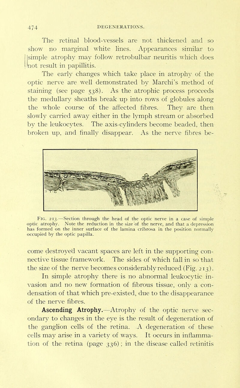 The retinal blood-vessels are not thickened and so show no marginal white lines. i\ppearances similar to [simple atrophy may follow retrobulbar neuritis which does •not result in papillitis. The early changes which take place in atrophy of the optic nerve are well demonstrated by Marchi's method of staining (see page 538). As the atrophic process proceeds the medullary sheaths break up into rows of globules along the whole course of the affected fibres. They are then slowly carried away either in the lymph stream or absorbed by the leukocytes. The axis-cylinders become beaded, then broken up, and finally disappear. As the nerve fibres be- FlG. 213.—Section through the head of the optic nerve in a case of simple optic atrophy. Note the reduction in the size of the nerve, and that a depression has formed on the inner surface of the lamina cribrosa in the position normally occupied by the optic papilla. come destroyed vacant spaces are left in the supporting con- nective tissue framework. The sides of which fall in so that the size of the nerve becomes considerably reduced (Fig. 213). In simple atrophy there is no abnormal leukocvtic in- \'asion and no new formation of fibrous tissue, only a con- densation of that which pre-existed, due to the disappearance of the nerve fibres. Ascending Atrophy.—Atrophy of the optic nerve sec- ondary to changes in the eye is the result of degeneration of the ganglion cells of the retina. A degeneration of these cells may arise in a variety of ways. It occurs in inflamma- tion of the retina (page 336); in the disease called retinitis