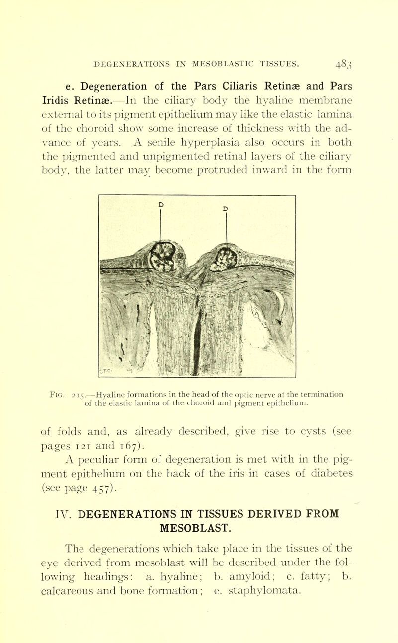 e. Degeneration of the Pars Ciliaris Retinae and Pars Iridis Retinae.—In the ciliary body the hyaline membrane external to its pigment epithelium may like the elastic lamina of the choroid show some increase of thickness with the ad- \-ance of vears. A senile hyperplasia also occurs in both the pigmented and unpigmented retinal layers of the ciliary body, the latter may become protruded inward in the form Fig. 215.—Hyaline formations in the head of the optic nerve at the termination of the elastic lamina of the choroid and pigment epithelium. of folds and, as already described, give rise to cysts (see pages 121 and 167). A peculiar form of degeneration is met with in the pig- ment epithelium on the back of the iris in cases of diabetes (see page 457). IV. DEGENERATIONS IN TISSUES DERIVED FROM MESOBLAST. The degenerations which take place in the tissvies of the eye derived from mesoblast will be described under the fol- lowing headings: a. hyaline; b. amyloid; c. fatty; b. calcareous and bone fomiation; e. staphylomata.