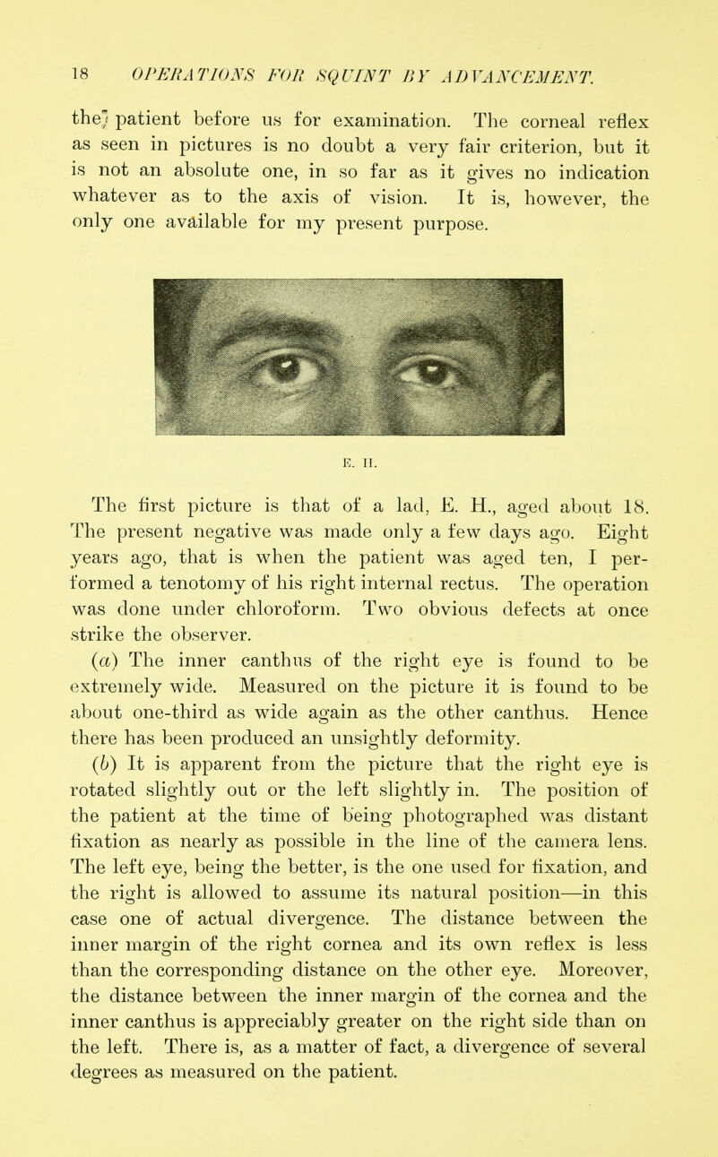 the patient before us for examination. The corneal reflex as seen in pictures is no doubt a very fair criterion, but it is not an absolute one, in so far as it gives no indication whatever as to the axis of vision. It is, however, the only one available for my present purpose. E. II. The first picture is that of a lad. E. H., aged about 18. The present negative was made only a few days ago. Eight years ago, that is when the patient was aged ten, I per- formed a tenotomy of his right internal rectus. The operation was done under chloroform. Two obvious defects at once strike the observer. (a) The inner canthus of the right eye is found to be extremely wide. Measured on the picture it is found to be about one-third as wide again as the other canthus. Hence there has been produced an unsightly deformity. (6) It is apparent from the picture that the right eye is rotated slightly out or the left slightly in. The position of the patient at the time of being photographed was distant fixation as nearly as possible in the line of the camera lens. The left eye, being the better, is the one used for fixation, and the right is allowed to assume its natural position—in this case one of actual divergence. The distance between the inner margin of the right cornea and its own reflex is less than the corresponding distance on the other eye. Moreover, the distance between the inner margin of the cornea and the inner canthus is appreciably greater on the right side than on the left. There is, as a matter of fact, a divergence of several degrees as measured on the patient.