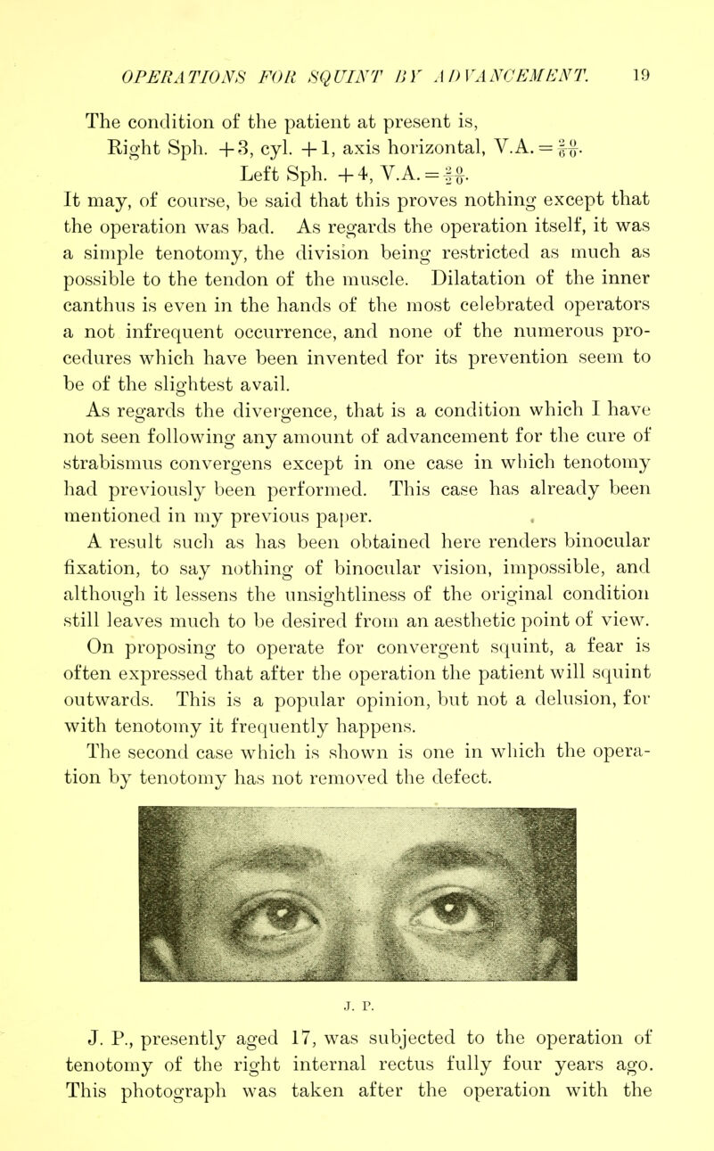 The condition of the patient at present is, Right Sph. +3, cyl. +1, axis horizontal, V.A. = f-§-. Left Sph. +4, V.A. = f£. It may, of course, be said that this proves nothing except that the operation was bad. As regards the operation itself, it was a simple tenotomy, the division being restricted as much as possible to the tendon of the muscle. Dilatation of the inner canthus is even in the hands of the most celebrated operators a not infrequent occurrence, and none of the numerous pro- cedures which have been invented for its prevention seem to be of the slightest avail. As regards the divergence, that is a condition which I have not seen following any amount of advancement for the cure of strabismus convergens except in one case in which tenotomy had previously been performed. This case has already been mentioned in my previous paper. A result such as has been obtained here renders binocular fixation, to say nothing of binocular vision, impossible, and although it lessens the unsightliness of the orio-inal condition o D o still leaves much to be desired from an aesthetic point of view. On proposing to operate for convergent squint, a fear is often expressed that after the operation the patient will squint outwards. This is a popular opinion, but not a delusion, for with tenotomy it frequently happens. The second case which is shown is one in which the opera- tion by tenotomy has not removed the defect. j. r. J. P., presently aged 17, was subjected to the operation of tenotomy of the right internal rectus fully four years ago. This photograph was taken after the operation with the