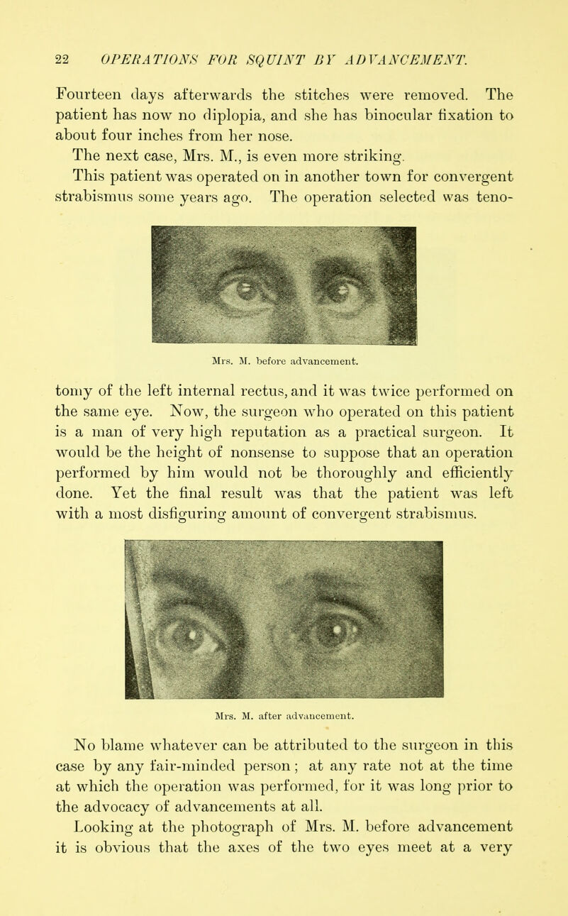 Fourteen clays afterwards the stitches were removed. The patient has now no diplopia, and she has binocular fixation to about four inches from her nose. The next case, Mrs. M., is even more striking. This patient was operated on in another town for convergent strabismus some years ago. The operation selected was teno- Mrs. M. before advancement. tomy of the left internal rectus, and it was twice performed on the same eye. Now, the surgeon who operated on this patient is a man of very high reputation as a practical surgeon. It would be the height of nonsense to suppose that an operation performed by him would not be thoroughly and efficiently done. Yet the final result was that the patient was left with a most disfiguring amount of convergent strabismus. Mrs. M. after advancement. No blame whatever can be attributed to the surgeon in this case by any fair-minded person; at any rate not at the time at which the operation was performed, for it was long prior to the advocacy of advancements at all. Looking at the photograph of Mrs. M. before advancement it is obvious that the axes of the two eyes meet at a very