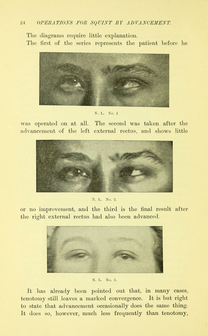 The diagrams require little explanation. The first of the series represents the patient before he N. L. No. 1 was operated on at all. The second was taken after the advancement of the left external rectus, and shows little N. L. No. 2. or no improvement, and the third is the final result after the right external rectus had also been advanced. N. L. No. 3. It has already been pointed out that, in many cases, tenotomy still leaves a marked convergence. It is but right to state that advancement occasionally does the same thing. It does so, however, much less frequently than tenotomy,