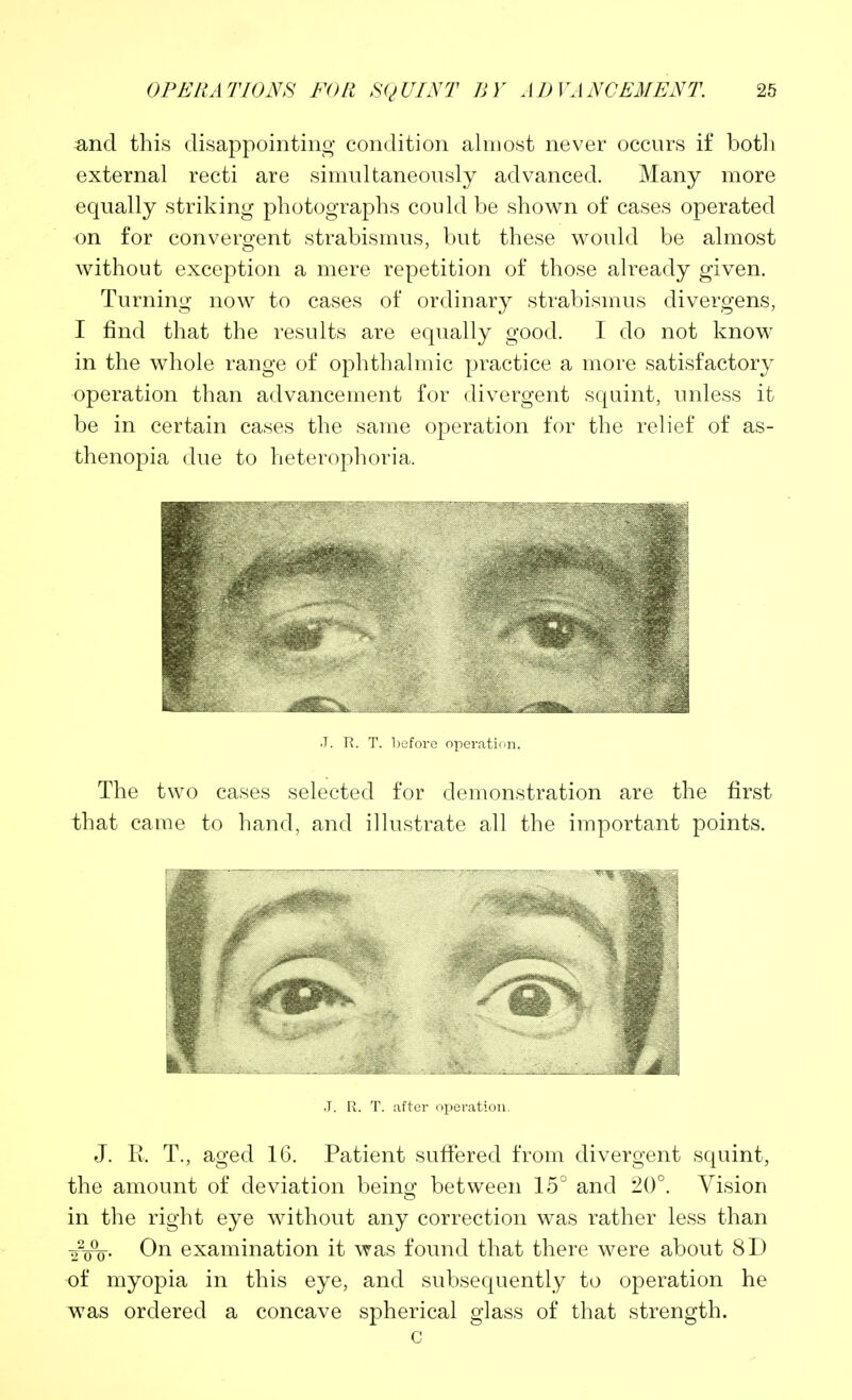 3,nd this disappointing condition almost never occurs if botli external recti are simultaneously advanced. Many more equally striking photographs could be shown of cases operated on for convergent strabismus, but these would be almost without exception a mere repetition of those already given. Turning now to cases of ordinary strabismus divergens, I find that the results are equally good. I do not know in the whole range of ophthalmic practice a more satisfactory operation than advancement for divergent squint, unless it be in certain cases the same operation for the relief of as- thenopia due to heterophoria. •T. T\. T. before operation. The two cases selected for demonstration are the first that came to hand, and illustrate all the important points. J. R. T. after operation. J. R. T., aged 16. Patient suffered from divergent squint, the amount of deviation being between 15° and 20°. Vision in the right eye without any correction was rather less than -2%. On examination it was found that there were about 8D of myopia in this eye, and subsequently to operation he was ordered a concave spherical glass of that strength. c