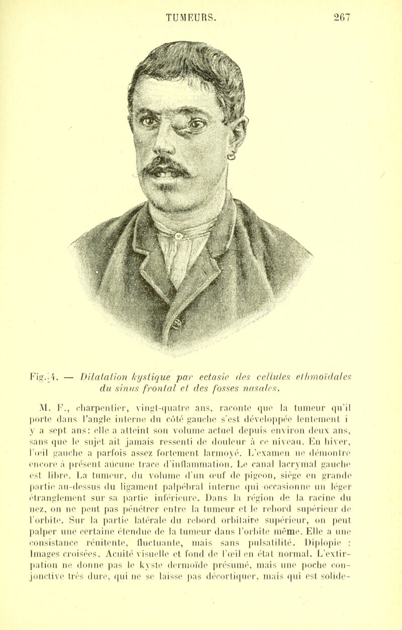 Fig.^4. — Dilatation kystique par ectasie des cellules; ethmoïdâles du sinus frontal et des fosses nasales. M. F., charpentier, vingt-quatre ans, raronte que la tumeur qu'il porte dans l'angle interne du côté gauche s'est développée lentement i y a sept ans: elle a atteint son volume actuel depuis environ deux ans, sans que le sujet ait jamais ressenti de douleur à ce niveau. En hiver, l'œil gauche a parfois assez fortement larmoyé. L'examen ne démontre encore à présen t aucune trace d'inflammation. Le canal lacrymal gauche est lihre. La tumeur, du volume d'un œuf de pigeon, siège en grande partie au-dessus du ligament palpébral interne qui occasionne un léger étranglement sur sa partie inférieure. Dans la région de la racine du nez, on ne peut pas pénétrer entre la tumeur et le rebord supérieur de l'orbite. Sur la partie latérale du rebord orbitaire supérieur, on peut palper une certaine étendue de la tumeur dans l'orbite même. Elle a une consistance rénitente, fluctuante, mais sans pulsatilité. Diplopie : Images croisées. Acuité visuelle et fond de l'œil en état normal. L'extir- pation ne donne pas le kyste dermoïde présumé, mais une poche con- jonctive très dure, qui ne se laisse pas décortiquer, mais qui est solide-