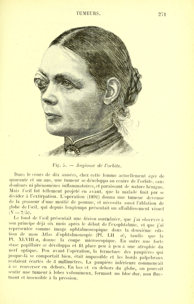 Eig. 5. — Angiome de l'orbite. Dans le cours de dix années, chez cette femme actuellement âgée de quarante et un ans, une tumeur se développa au centre de l'orbite, sans douleurs ni phénomènes inflammatoires, et paraissant de nature bénigne. Mais l'œil fut tellement projeté en avant, que la malade finit par se décider à, l'extirpation. L'opération (18(.)l) donna une tumeur devenue de la grosseur d'une moitié de pomme, et nécessita aussi l'ablation de globe de l'œil, qui depuis longtemps présentait un affaiblissement visuel (V=2/5). Le fond de l'œil présentait une lésion maculaire, que j'ai observée à son principe déjà six mois après le début de l'exophtalmie, et que j'ai représentée comme image opbtalmoseopique dans la deuxième édi- tion de mon Atlas d'ophtalmoscopie (Pl. LU a), taudis que la Pl. XLVIII «, donne la coupe microscopique. En outre une forte stase papillaire se développa et fit place peu à peu à une atrophie du nerf optique. Peu avant l'opération, la fermeture des paupières qui jusque-là se comportait bien, était impossible et les bords palpébraux restaient écartés de 3 millimètres. La paupière inférieure commençait à se renverser en dehors. En bas et en debors du globe, on pouvait sentir une tumeur à lobes volumineux, formant un bloc dur, non fluc- tuant et insensible à la pression.