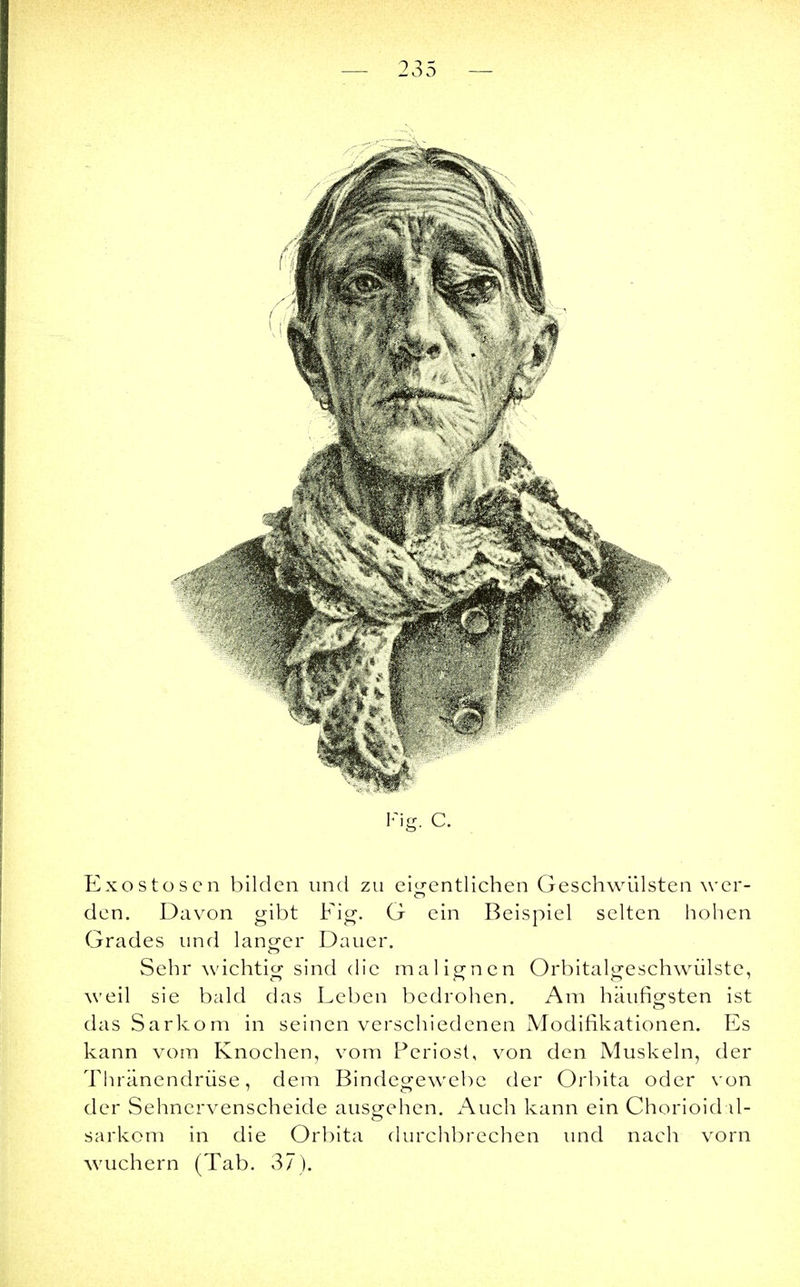 Fig. C. Exostosen bilden und zu eigentlichen Geschwülsten wer- den. Davon gibt Fig. G ein Beispiel selten hohen Grades und langer Dauer. Sehr wichtig sind die malignen Orbitalgeschwülste, weil sie bald das Leben bedrohen. Am häufigsten ist das Sarkom in seinen verschiedenen Modifikationen. Es kann vom Knochen, vom Periost, von den Muskeln, der Thränendrüse, dem Bindegewebe der Orbita oder von der Sehnervenscheide ausgehen. Auch kann ein Chorioid il- sarkom in die Orbita durchbrechen und nach vorn wuchern (Tab. 37).