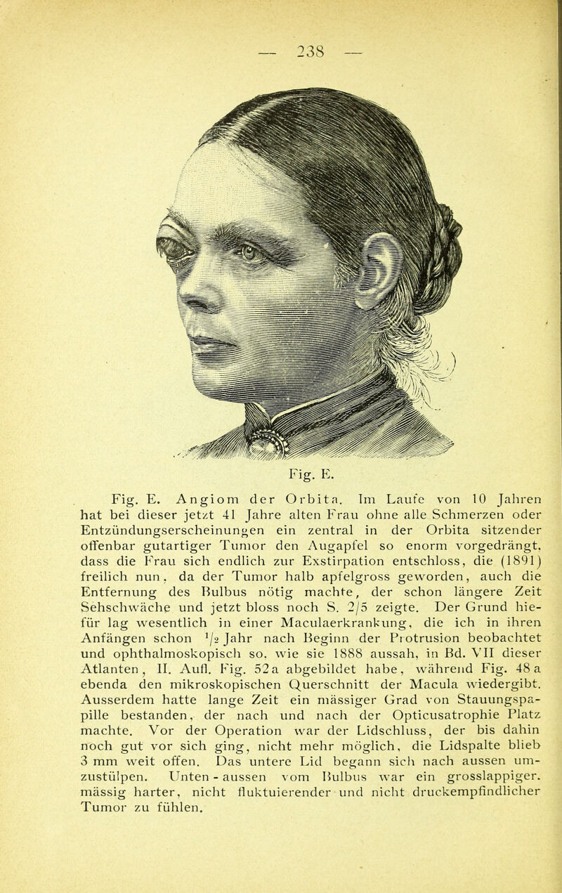 Fig. E. Fig. E. Angiom der Orbita. Im Laufe von 10 Jahren hat bei dieser jetzt 41 Jahre alten Frau ohne alle Schmerzen oder Entzündungserscheinungen ein zentral in der Orbita sitzender offenbar gutartiger Tumor den Augapfel so enorm vorgedrängt, dass die Frau sich endlich zur Exstirpation entschloss, die (1891) freilich nun. da der Tumor halb apfelgross geworden, auch die Entfernung des Bulbus nötig machte, der schon längere Zeit Sehschwäche und jetzt bloss noch S. 2/5 zeigte. Der Grund hie- für lag wesentlich in einer Maculaerkrankung, die ich in ihren Anfängen schon 1j-2 Jahr nach Beginn der Protrusion beobachtet und ophthalmoskopisch so. wie sie 1888 aussah, in Bd. VII dieser Atlanten, II. Aufl. Fig. 52a abgebildet habe, während Fig. 48a ebenda den mikroskopischen Querschnitt der Macula wiedergibt. Ausserdem hatte lange Zeit ein massiger Grad von Stauungspa- pille bestanden, der nach und nach der Opticusatrophie Platz machte. Vor der Operation war der Lidschluss, der bis dahin noch gut vor sich ging, nicht mehr möglich, die Lidspalte blieb 3 mm weit offen. Das untere Lid begann sich nach aussen um- zustülpen. Unten - aussen vom Bulbus war ein grosslappiger, mässig harter, nicht fluktuierender und nicht druckempfindlicher Tumor zu fühlen.