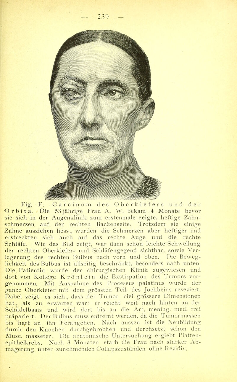Fig. F. Carcinom des Oberkiefers und der Orbita. Die 53 jährige Frau A. W. bekam 4 Monate bevor sie sich in der Augenklinik zum erstenmale zeigte, heftige Zahn- schmerzen auf der rechten Backenseite. Trotzdem sie einige Zähne ausziehen Hess , wurden die Schmerzen aber heftiger und erstreckten sich auch auf das rechte Auge und die rechte Schläfe. Wie das Bild zeigt, war dann schon leichte Schwellung der rechten Oberkiefer- und Schläfengegend sichtbar, sowie Ver- lagerung des rechten Bulbus nach vorn und oben. Die Beweg- lichkeit des Bulbus ist allseitig beschränkt, besonders nach unten. Die Patientin wurde der chirurgischen Klinik zugewiesen und dort von Kollege Krönlein die Exstirpation des Tumors vor- genommen. Mit Ausnahme des Processus palatinus wurde der ganze Oberkiefer mit dem grössten Teil des Jochbeins reseziert. Dabei zeigt es sich, dass der Tumor viel grössere Dimensionen hat, als zu erwarten war: er reicht weit nach hinten an der Schädelbasis und wird dort bis an die Art. mening. med. frei präpariert. Der Bulbus muss entfernt werden, da die Tumormassen bis hart an ihn 1 erangehen. Nach aussen ist die Neubildung •durch den Knochen durchgebrochen und durchsetzt schon den Muse, masseter. Die anatomische Untersuchung ergiebt Platten- epithelkrebs. Nach 3 Monaten starb die Frau nach starker Ab- magerung unter zunehmenden Collapszuständen ohne Rezidiv.