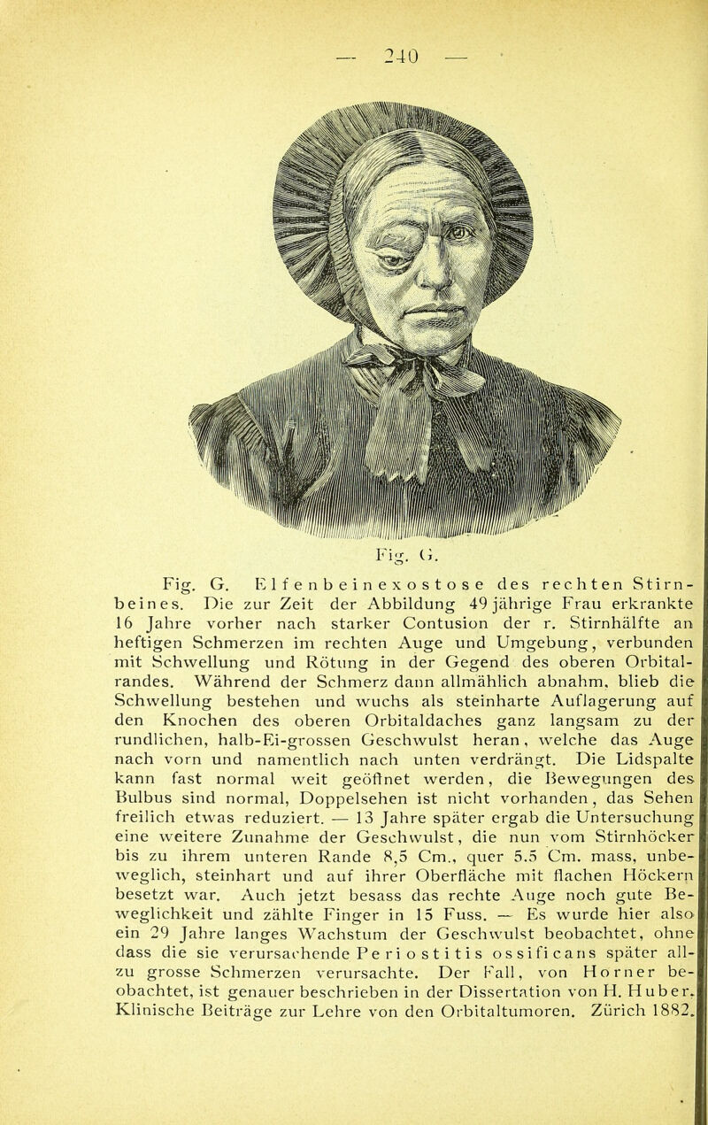 Fig. G. Elfenbeinexostose des rechten Stirn- beines. Die zur Zeit der Abbildung 49 jährige Frau erkrankte 16 Jahre vorher nach starker Contusion der r. Stirnhälfte an heftigen Schmerzen im rechten Auge und Umgebung, verbunden mit Schwellung und Rötung in der Gegend des oberen Orbital- randes. Während der Schmerz dann allmählich abnahm, blieb die Schwellung bestehen und wuchs als steinharte Auflagerung auf den Knochen des oberen Orbitaldaches ganz langsam zu der rundlichen, halb-Ei-grossen Geschwulst heran, welche das Auge nach vorn und namentlich nach unten verdrängt. Die Lidspalte kann fast normal weit geöffnet werden, die Bewegungen des Bulbus sind normal, Doppelsehen ist nicht vorhanden , das Sehen freilich etwas reduziert. — 13 Jahre später ergab die Untersuchung eine weitere Zunahme der Geschwulst, die nun vom Stirnhöcker bis zu ihrem unteren Rande 8,5 Cm., quer 5.5 Cm. mass, unbe- weglich, steinhart und auf ihrer Oberfläche mit flachen Höckern besetzt war. Auch jetzt besass das rechte Auge noch gute Be- weglichkeit und zählte Finger in 15 Fuss. — Es wurde hier also ein 29 Jahre langes Wachstum der Geschwulst beobachtet, ohne dass die sie verursachende Pe ri o s t i ti s ossificans später all- zu grosse Schmerzen verursachte. Der Fall, von Horner be- obachtet, ist genauer beschrieben in der Dissertation von H. Huber. Klinische Beiträge zur Lehre von den Orbitaltumoren. Zürich 1882.