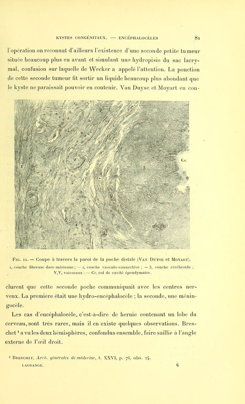 l'opération on reconnut d'ailleurs l'existence d'une seconde petite tumeur située beaucoup plus en avant et simulant une hydropisie du sac lacrv- mal, confusion sur laquelle de Wecker a appelé l'attention. La ponction de cette seconde tumeur fit sortir un liquide beaucoup plus abondant que le kyste ne paraissait pouvoir en contenir. Van Duyse et Moyart en con- Fig. 11.— Coupe à travers la paroi de la poche distale (Van Duyse et Moyart). i, couche fibreuse dure-mérienne j— 2, couche vasculo-comiective ; —3, couche cérébroïde ; V,V, vaisseaux ; — Ce, col de cavité épendymaire. durent que cette seconde poche communiquait avec les centres ner- veux. La première était une hydro-encéphalocèle ; la seconde, une ménin- gocèle. Les cas d'encéphalocèle, c'est-à-dire de hernie contenant un lobe du cerveau, sont très rares, mais il en existe quelques observations. Bres- chet1 a vu les deux hémisphères, confondus ensemble, faire saillie à l'angle externe de l'œil droit. Bheschet, Arch. générales de médecine, t. XXVI, p. 76, obs. 2/J. LAGRANGE. 6