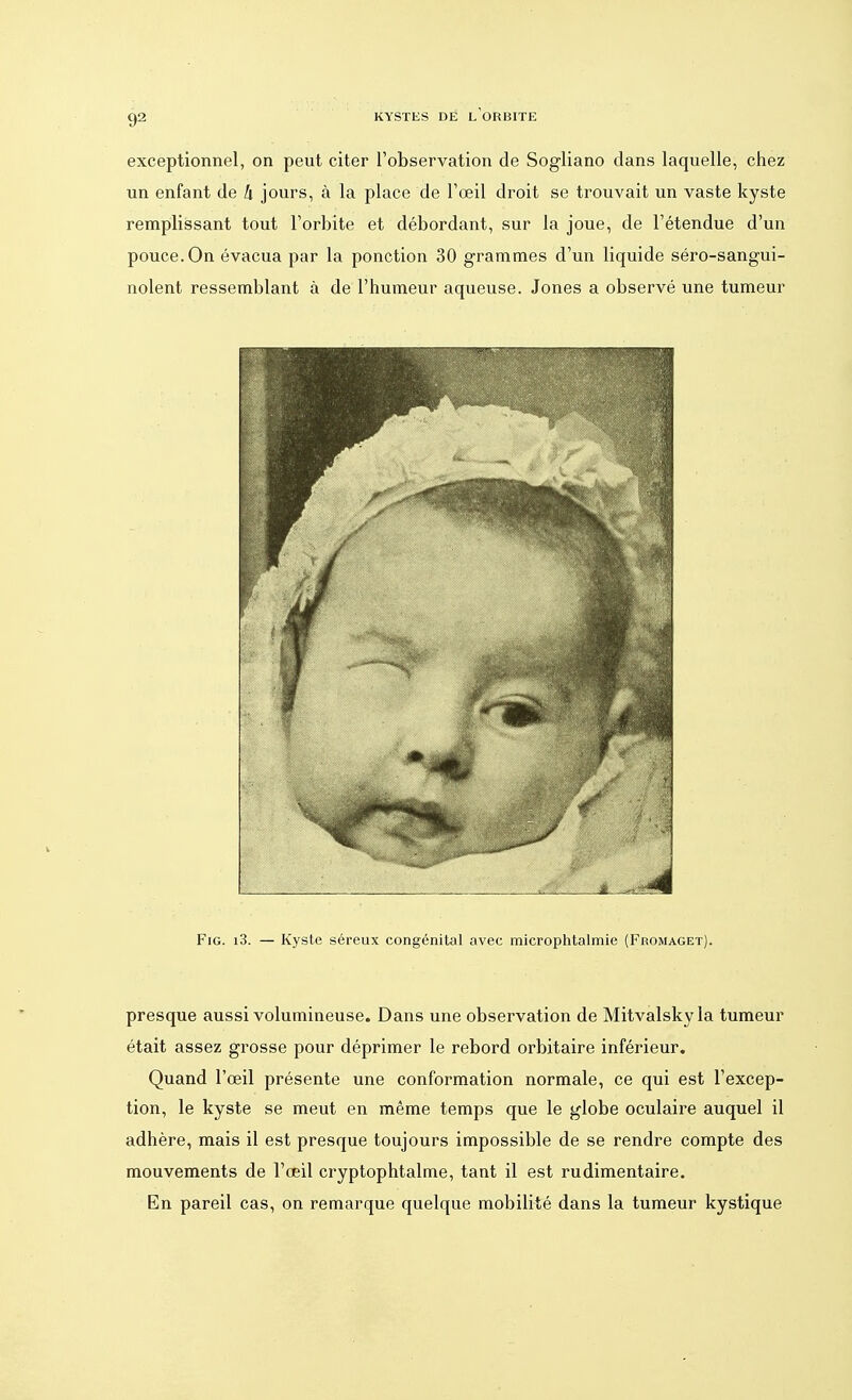 C)2 KYSTES DÉ i/ORBITE exceptionnel, on peut citer l'observation de Sogliano dans laquelle, chez un enfant de h jours, à la place de l'œil droit se trouvait un vaste kyste remplissant tout l'orbite et débordant, sur la joue, de l'étendue d'un pouce. On évacua par la ponction 30 grammes d'un liquide séro-sangui- nolent ressemblant à de l'humeur aqueuse. Jones a observé une tumeur Fig. i3. — Kyste séreux congénital avec microphtalmie (Fromaget). presque aussi volumineuse. Dans une observation de Mitvalskyla tumeur était assez grosse pour déprimer le rebord orbitaire inférieur. Quand l'œil présente une conformation normale, ce qui est l'excep- tion, le kyste se meut en même temps que le globe oculaire auquel il adhère, mais il est presque toujours impossible de se rendre compte des mouvements de l'œil cryptophtalme, tant il est rudimentaire. En pareil cas, on remarque quelque mobilité dans la tumeur kystique