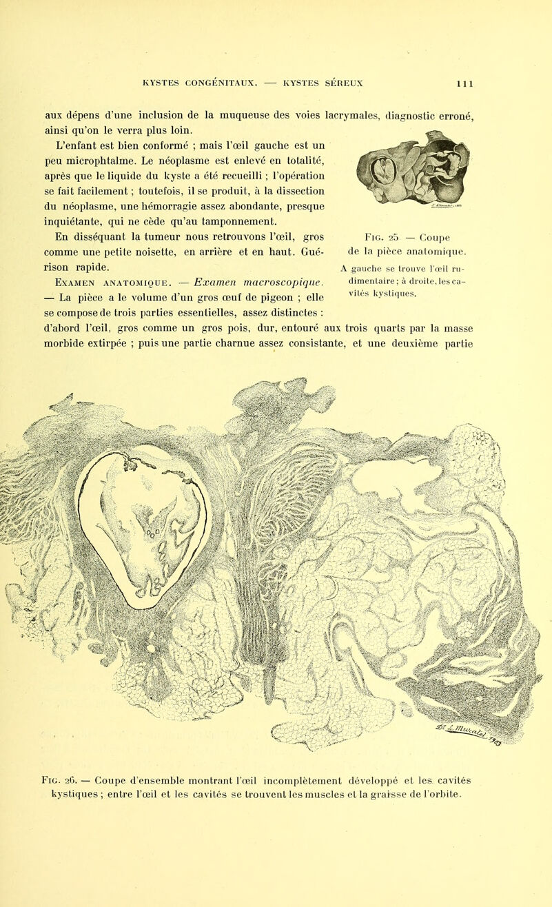 aux dépens d'une inclusion de la muqueuse des voies lacrymales, diagnostic erroné, ainsi qu'on le verra plus loin. L'enfant est bien conformé ; mais l'œil gauche est un peu microphtalme. Le néoplasme est enlevé en totalité, après que le liquide du kyste a été recueilli ; l'opération se fait facilement ; toutefois, il se produit, à la dissection du néoplasme, une hémorragie assez abondante, presque inquiétante, qui ne cède qu'au tamponnement. En disséquant la tumeur nous retrouvons l'œil, gros comme une petite noisette, en arrière et en haut. Gué- rison rapide. Examen anatomioue. — Examen macroscopique. — La pièce a le volume d'un gros œuf de pigeon ; elle se compose de trois parties essentielles, assez distinctes : d'abord l'œil, gros comme un gros pois, dur, entouré aux trois quarts par la masse morbide extirpée ; puis une partie charnue assez consistante, et une deuxième partie Fig. 25 — Coupe de la pièce anatomique. A gauche se trouve l'oeil ru- dimcnlaire; à droite, les ca- vités kystiques. mm m Fig. 26. — Coupe d'ensemble montrant l'œil incomplètement développé et les cavités kystiques; entre l'œil et les cavités se trouvent les muscles et la graisse de l'orbite.