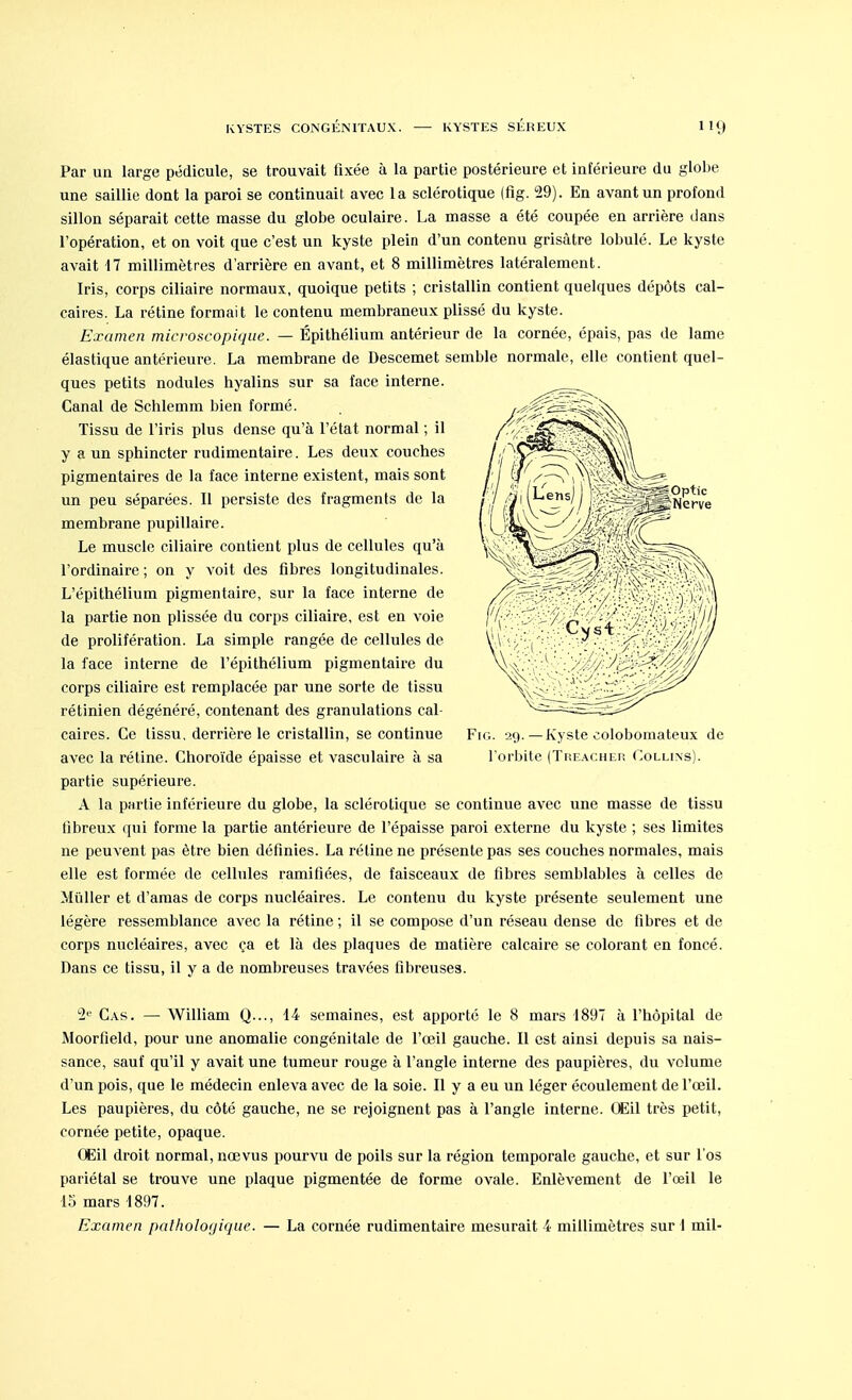 Par un large pédicule, se trouvait fixée à la partie postérieure et inférieure du globe une saillie dont la paroi se continuait avec la sclérotique (flg. 29). En avant un profond sillon séparait cette masse du globe oculaire. La masse a été coupée en arrière dans l'opération, et on voit que c'est un kyste plein d'un contenu grisâtre lobulé. Le kyste avait 17 millimètres d'arrière en avant, et 8 millimètres latéralement. Iris, corps ciliaire normaux, quoique petits ; cristallin contient quelques dépôts cal- caires. La rétine formait le contenu membraneux plissé du kyste. Examen microscopique. — Épithélium antérieur de la cornée, épais, pas de lame élastique antérieure. La membrane de Descemet semble normale, elle contient quel- ques petits nodules hyalins sur sa face interne. Canal de Schlemm bien formé. Tissu de l'iris plus dense qu'à l'état normal ; il y a un sphincter rudimentaire. Les deux couches pigmentaires de la face interne existent, mais sont un peu séparées. Il persiste des fragments de la membrane pupillaire. Le muscle ciliaire contient plus de cellules qu'à l'ordinaire; on y voit des fibres longitudinales. L'épithélium pigmentaire, sur la face interne de la partie non plissée du corps ciliaire, est en voie de prolifération. La simple rangée de cellules de la face interne de l'épithélium pigmentaire du corps ciliaire est remplacée par une sorte de tissu rétinien dégénéré, contenant des granulations cal- caires. Ce tissu, derrière le cristallin, se continue Fie. 29. —Kyste colobomateux de avec la rétine. Choroïde épaisse et vasculaire à sa l'orbite (Treacher Collins). partie supérieure, A la partie inférieure du globe, la sclérotique se continue avec une masse de tissu tibreux qui forme la partie antérieure de l'épaisse paroi externe du kyste ; ses limites ne peuvent pas être bien définies. La rétine ne présente pas ses couches normales, mais elle est formée de cellules ramifiées, de faisceaux de fibres semblables à celles de Millier et d'amas de corps nucléaires. Le contenu du kyste présente seulement une légère ressemblance avec la rétine ; il se compose d'un réseau dense de fibres et de corps nucléaires, avec ça et là des plaques de matière calcaire se colorant en foncé. Dans ce tissu, il y a de nombreuses travées fibreuses. 2e Cas. — William Q..., 14 semaines, est apporté le 8 mars 1897 à l'hôpital de Moorfield, pour une anomalie congénitale de l'œil gauche. Il est ainsi depuis sa nais- sance, sauf qu'il y avait une tumeur rouge à l'angle interne des paupières, du volume d'un pois, que le médecin enleva avec de la soie. Il y a eu un léger écoulement de l'œil. Les paupières, du côté gauche, ne se rejoignent pas à l'angle interne. Œil très petit, cornée petite, opaque. Œil droit normal, nœvus pourvu de poils sur la région temporale gauche, et sur l'os pariétal se trouve une plaque pigmentée de forme ovale. Enlèvement de l'œil le 15 mars 1897. Examen pathologique. — La cornée rudimentaire mesurait 4 millimètres sur i mil-