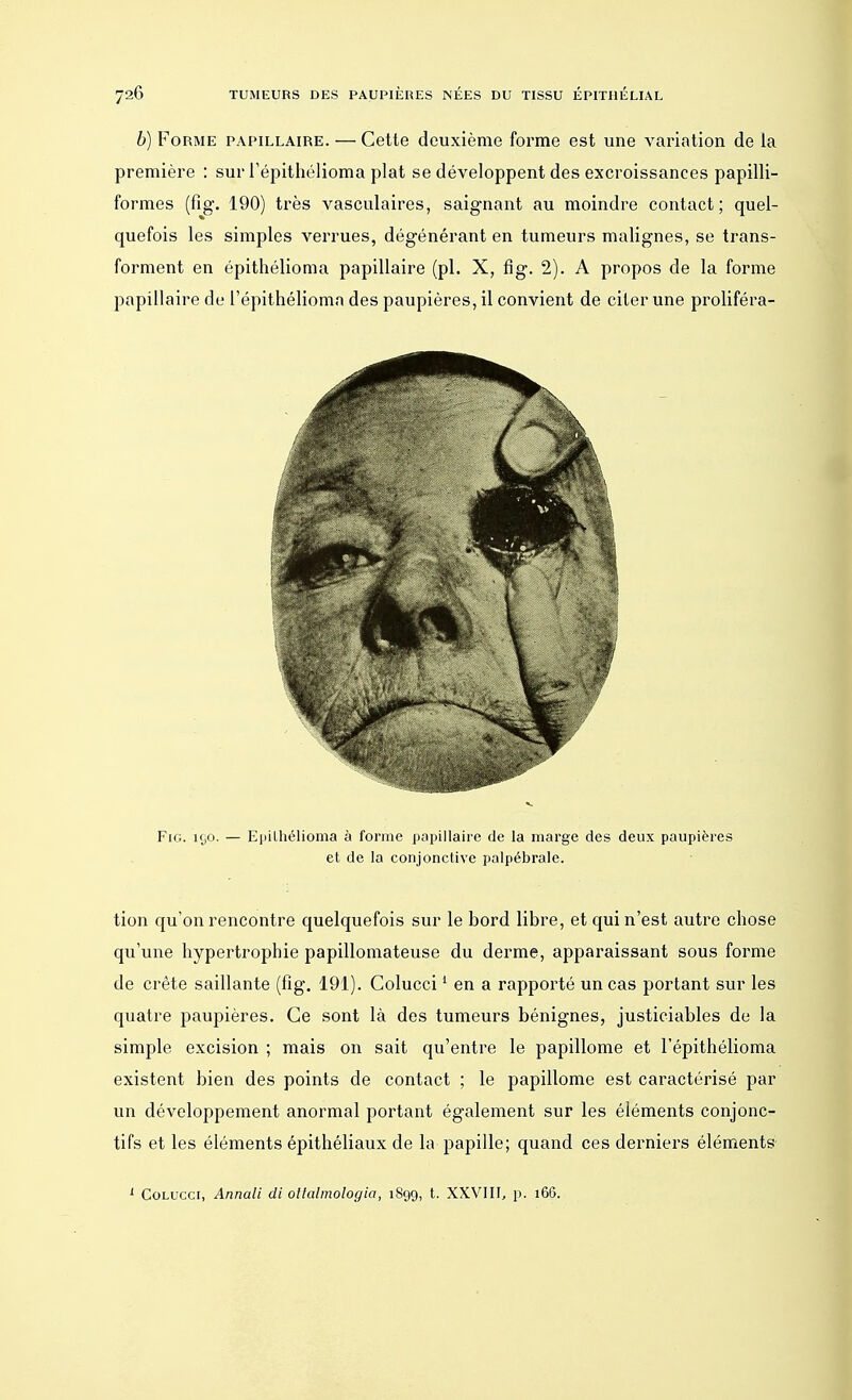 b) Forme papillaire. — Cette deuxième forme est une variation de la première : sur l'épithélioma plat se développent des excroissances papilli- formes (fig. 190) très vasculaires, saignant au moindre contact; quel- quefois les simples verrues, dégénérant en tumeurs malignes, se trans- forment en épithélioma papillaire (pl. X, fig. 2). A propos de la forme papillaire de l'épithélioma des paupières, il convient de citer une proliféra- Fig. 190. — Epilhélioma à forme papillaire de la marge des deux paupières et de la conjonctive palpébrale. tion qu'on rencontre quelquefois sur le bord libre, et qui n'est autre chose qu'une hypertrophie papillomateuse du derme, apparaissant sous forme de crête saillante (fig. 191). Colucci1 en a rapporté un cas portant sur les quatre paupières. Ce sont là des tumeurs bénignes, justiciables de la simple excision ; mais on sait qu'entre le papillome et l'épithélioma existent bien des points de contact ; le papillome est caractérisé par un développement anormal portant également sur les éléments conjonc- tifs et les éléments épithéliaux de la papille; quand ces derniers éléments 1 Colucci, Annali di ollalmologia, 1899, t. XXVIII, p. 166.