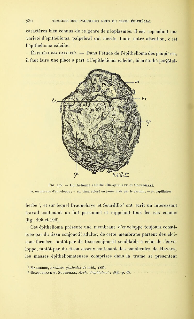 caractères bien connus de ce genre de néoplasmes. Il est cependant une variété d epithélioma palpébral qui mérite toute notre attention, c'est l'épithélioma calcifié. Épithélioma calcifié. — Dans l'étude de l'épithélioma des paupières, il faut faire une place à part à l'épithélioma calcifié, bien étudié par|Mal- Fig. 195. — Epithélioma calcifié (Braquehaye et Sourdille). m, membrane d'enveloppe; - ep, tissu coloré en jaune clair par le carmin; — vc, capillaires. herbe 1, et sur lequel Braquehaye et Sourdille2 ont écrit un intéressant travail contenant un fait personnel et rappelant tous les cas connus (fig. 195 et 196). Cet épithélioma présente une membrane d'enveloppe toujours consti- tuée par du tissu conjonctif adulte ; de cette membrane partent des cloi- sons formées, tantôt par du tissu conjonctif semblable à celui de l'enve- loppe, tantôt par du tissu osseux contenant des canalicules de Havers ; les masses épithéliomateuses comprises dans la trame se présentent 1 Malherbe, Archives générales de méd., i885. 2 Braquehaye et Sourdille, Arch. d'ophtalmol.f 1895, p* 65.