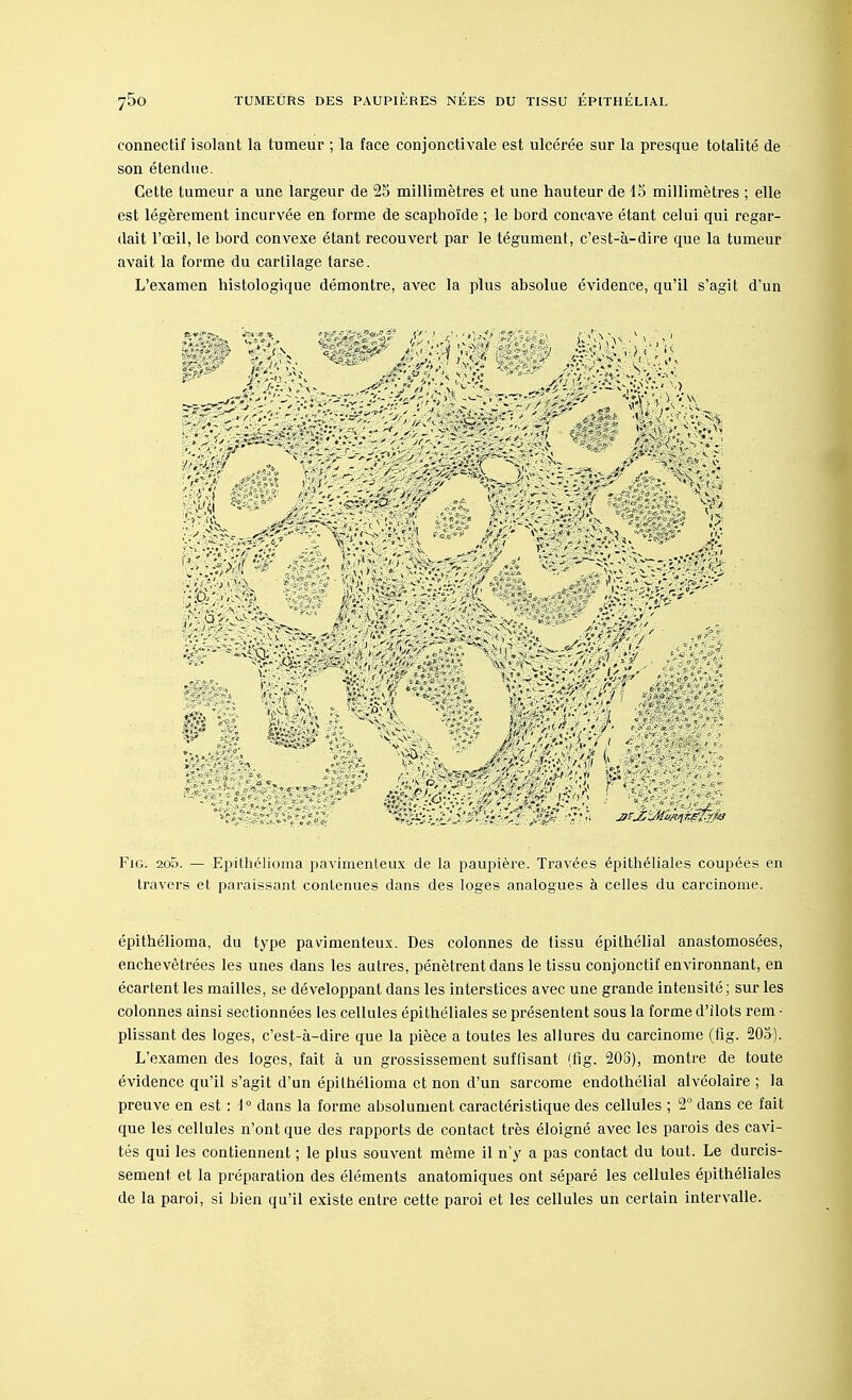connectif isolant la tumeur ; la face conjonctivale est ulcérée sur la presque totalité de son étendue. Cette tumeur a une largeur de 25 millimètres et une hauteur de 15 millimètres ; elle est légèrement incurvée en forme de scaphoïde ; le bord concave étant celui qui regar- dait l'œil, le bord convexe étant recouvert par le tégument, c'est-à-dire que la tumeur avait la forme du cartilage tarse. L'examen histologique démontre, avec la plus absolue évidence, qu'il s'agit d'un Fig. 2o5. — Epithélioma pavimenteux de la paupière. Travées épithéliales coupées en travers et paraissant contenues dans des loges analogues à celles du carcinome. épithélioma, du type pavimenteux. Des colonnes de tissu épithélial anastomosées, enchevêtrées les unes dans les autres, pénètrent dans le tissu conjonctif environnant, en écartent les mailles, se développant dans les interstices avec une grande intensité ; sur les colonnes ainsi sectionnées les cellules épithéliales se présentent sous la forme d'ilots rem - plissant des loges, c'est-à-dire que la pièce a toutes les allures du carcinome (fig. 205). L'examen des loges, fait à un grossissement suffisant (fig. 205), montre de toute évidence qu'il s'agit d'un épithélioma et non d'un sarcome endothélial alvéolaire ; la preuve en est : 1° dans la forme absolument caractéristique des cellules ; 2° dans ce fait que les cellules n'ont que des rapports de contact très éloigné avec les parois des cavi- tés qui les contiennent ; le plus souvent même il n'y a pas contact du tout. Le durcis- sement et la préparation des éléments anatomiques ont séparé les cellules épithéliales de la paroi, si bien qu'il existe entre cette paroi et les cellules un certain intervalle.