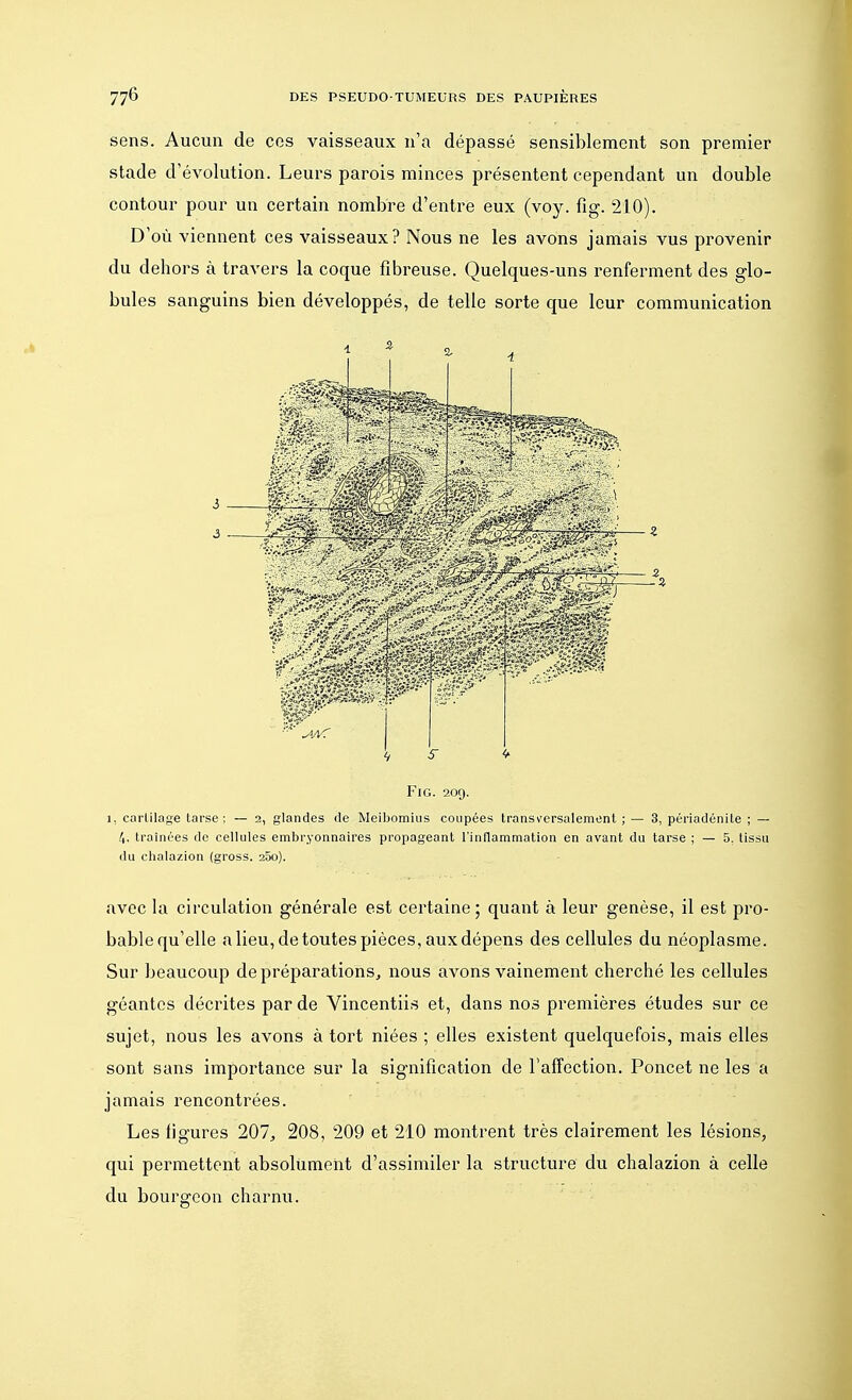 sens. Aucun de ces vaisseaux n'a dépassé sensiblement son premier stade d'évolution. Leurs parois minces présentent cependant un double contour pour un certain nombre d'entre eux (voy. fig. 210). D'où viennent ces vaisseaux? Nous ne les avons jamais vus provenir du dehors à travers la coque fibreuse. Quelques-uns renferment des glo- bules sanguins bien développés, de telle sorte que leur communication z Fig. 209. 1, cartilage tarse; — 2, glandes de Meibomius coupées transversalement; — 3, périadénite ; — 4, traînées de cellules embryonnaires propageant l'inflammation en avant du tarse ; — 5, tissu du chalazion (gross. 25o). avec la circulation générale est certaine; quant à leur genèse, il est pro- bable qu'elle a lieu, de toutes pièces, aux dépens des cellules du néoplasme. Sur beaucoup de préparations, nous avons vainement cherché les cellules géantes décrites par de Vincentiis et, dans nos premières études sur ce sujet, nous les avons à tort niées ; elles existent quelquefois, mais elles sont sans importance sur la signification de l'affection. Poncet ne les a jamais rencontrées. Les ligures 207, 208, 209 et 210 montrent très clairement les lésions, qui permettent absolument d'assimiler la structure du chalazion à celle du bourgeon charnu.