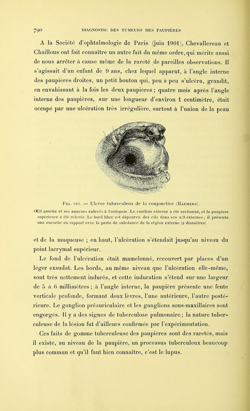 A la Société d'ophtalmologie de Paris (juin 1901), Ghevallereau et Chaillous ont fait connaître un autre fait du même ordre, qui mérite aussi de nous arrêter à cause même de la rareté de pareilles observations. Il s'agissait d'un enfant de 9 ans, chez lequel apparut, à l'angle interne des paupières droites, un petit bouton qui, peu à peu s'ulcéra, grandit, en envahissant à la fois les deux paupières ; quatre mois après l'angle interne des paupières, sur une longueur d'environ 1 centimètre, était occupé par une ulcération très irrégulière, surtout à l'union de la peau Fig. 212. — Ulcère tuberculeux de la conjonctive (Haemers). OEil gauche et ses annexes enlevés à l'autopsie. Le canthus externe a été sectionné, et la paupière supérieure a été relevée. Le bord libre est dépourvu des cils dans ses 2/3 externes; il présente une encoche en rapport avec la perte de substance de la région externe (2 diamètres) et de la muqueuse ; en haut, l'ulcération s'étendait jusqu'au niveau du point lacrymal supérieur. Le fond de l'ulcération était mamelonné, recouvert par places d'un léger exsudât. Les bords, au même niveau que l'ulcération elle-même, sont très nettement indurés, et cette induration s'étend sur une largeur de 5 à 6 millimètres ; à l'angle interne, la paupière présente une fente verticale profonde, formant deux lèvres, l'une antérieure, l'autre posté- rieure. Le ganglion préauriculaire et les ganglions sous-maxillaires sont engorgés. Il y a des signes de tuberculose pulmonaire ; la nature tuber- culeuse de la lésion fut d'ailleurs confirmée par l'expérimentation. Ces faits de gomme tuberculeuse des paupières sont des raretés, mais il existe, au niveau de la paupière, un processus tuberculeux beaucoup plus commun et qu'il faut bien connaître, c'est le lupus.