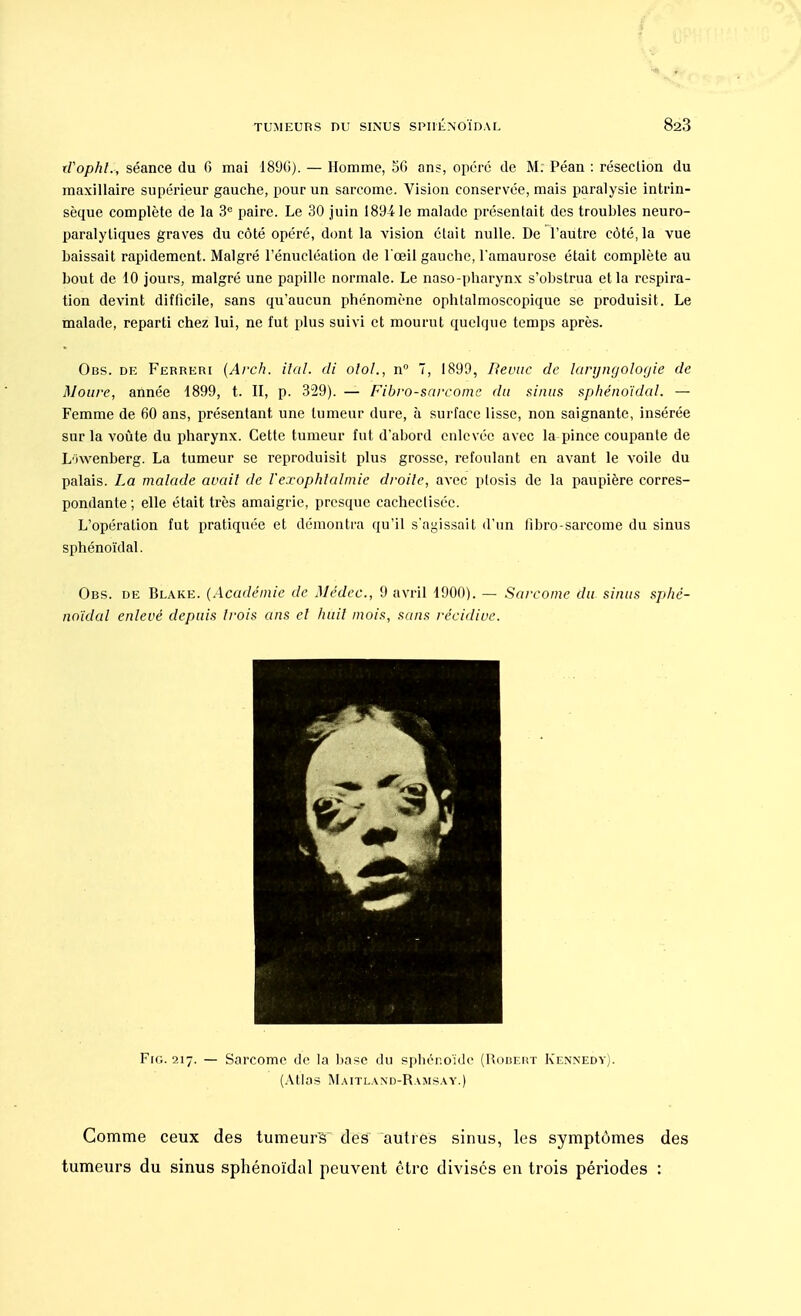 tVophl.-, séance du 6 mai 1896). — Homme, 56 ans, opéré de M; Péan : résection du maxillaire supérieur gauche, pour un sarcome. Vision conservée, mais paralysie intrin- sèque complète de la 3e paire. Le 30 juin 18941e malade présentait des troubles neuro- paralytiques graves du côté opéré, dont la vision était nulle. De l'autre côté, la vue baissait rapidement. Malgré l'énucléation de l'œil gauche, l'amaurose était complète au bout de 10 jours, malgré une papille normale. Le naso-pharynx s'obstrua et la respira- tion devint difficile, sans qu'aucun phénomène ophtalmoscopique se produisit. Le malade, reparti chez lui, ne fut plus suivi et mourut quelque temps après. Obs. de Ferreri (Arch. ital. di otol., n° 7, 1899, Revue de laryngologie de Moure, année 1899, t. II, p. 329). — Fibro-sarcomc du sinus sphénoïdal. — Femme de 60 ans, présentant une tumeur dure, à surface lisse, non saignante, insérée sur la voûte du pharynx. Cette tumeur fut d'abord enlevée avec la pince coupante de L'iwenberg. La tumeur se reproduisit plus grosse, refoulant en avant le voile du palais. La malade avait de Vexophialmic droite, avec ptosis de la paupière corres- pondante ; elle était très amaigrie, presque cachecliséc. L'opération fut pratiquée et démontra qu'il s'agissait d'un fibro-sarcome du sinus sphénoïdal. Obs. de Blake. (Académie de Médec., 9 avril 1900). — Sarcome du sinus sphé- noïdal enlevé depuis trois ans et huit mois, sans récidive. Fig. 217. — Sarcome de la base du sphénoïde (Rodeut Kennedy). (Atlas Maitland-Ramsay.) Comme ceux des tumeurs des autres sinus, les symptômes des tumeurs du sinus sphénoïdal peuvent être divisés en trois périodes :