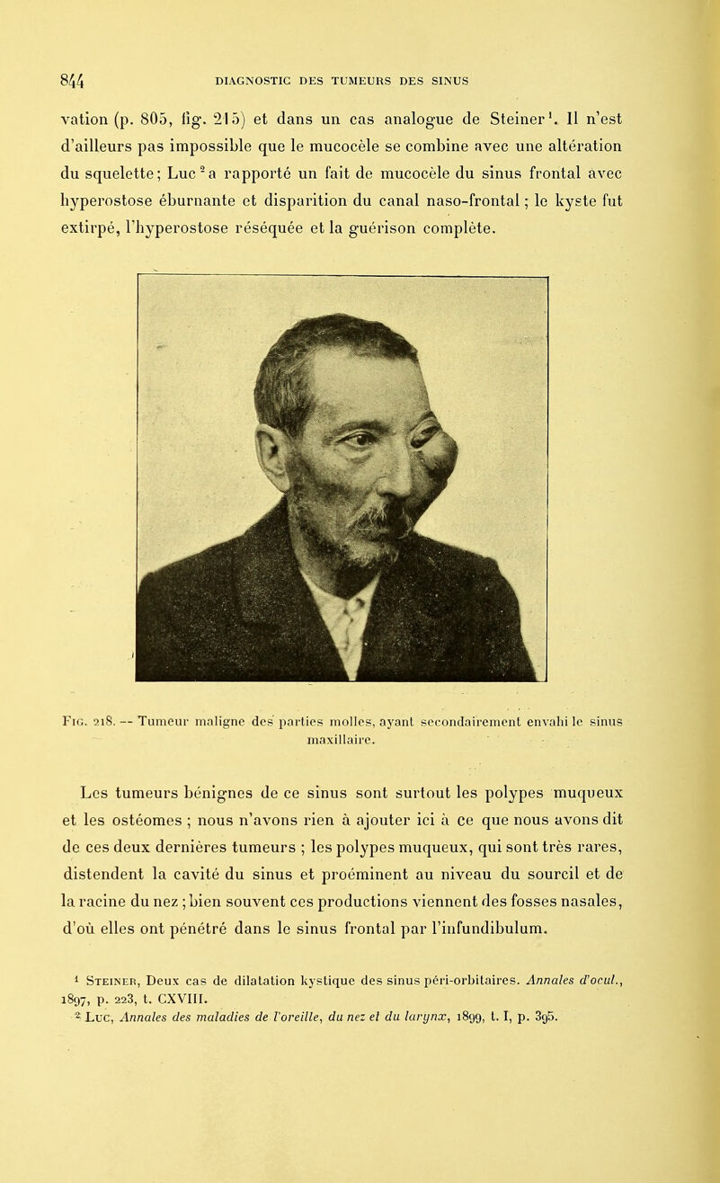 vation (p. 805, fig. 215) et dans un cas analogue de Steiner1. Il n'est d'ailleurs pas impossible que le mucocèle se combine avec une altération du squelette; Luc2a rapporté un fait de mucocèle du sinus frontal avec hyperostose éburnante et disparition du canal naso-frontal ; le kyste fut extirpé, l'hyperostose réséquée et la guérison complète. Fig. 21S. — Tumeur maligne des parties molles, ayant secondairement envahi le sinus maxillaire. Les tumeurs bénignes de ce sinus sont surtout les polypes muqueux et les ostéomes ; nous n'avons rien à ajouter ici à ce que nous avons dit de ces deux dernières tumeurs ; les polypes muqueux, qui sont très rares, distendent la cavité du sinus et proéminent au niveau du sourcil et de la racine du nez ;bien souvent ces productions viennent des fosses nasales, d'où elles ont pénétré dans le sinus frontal par l'infundibulum. 1 Steiner, Deux cas de dilatation kystique des sinus péri-orbitaires. Annales d'ocul., 1897, p. 223, t. CXVIII. % Luc, Annales des maladies de l'oreille, du nez el du larynx, 1899, 1.1, p. 3g5.