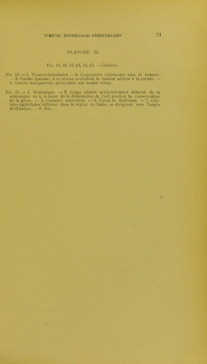 PLANCHE III. Fui. lo, 11,12,13, L4, 15. — Cellules. \?t<3. 1G. — 1. Tumeurépibulbaire — 2. Conjonctive s'insinuant sous la tumeur. — 8. Cornée épaissie ; à ce niveau seulement la tumeur adhère à la cornée. — i. Cornéû transparente, permettant une bonne vision. Fiu. 17. — 1. Sclérotique. — 2. Corps ciliaire artificiellement détaché de la sclérotique en 4, à cause de la déformation de l'œil pendant la conservation de la pièce. - .>. Chambre antérieure. — 6. Canal de Schlemm. — T. Cel- lules épithéliales infiltrées dans la région du limbe, se dirigeant vers l'angle do filtration. — 8. Iris.