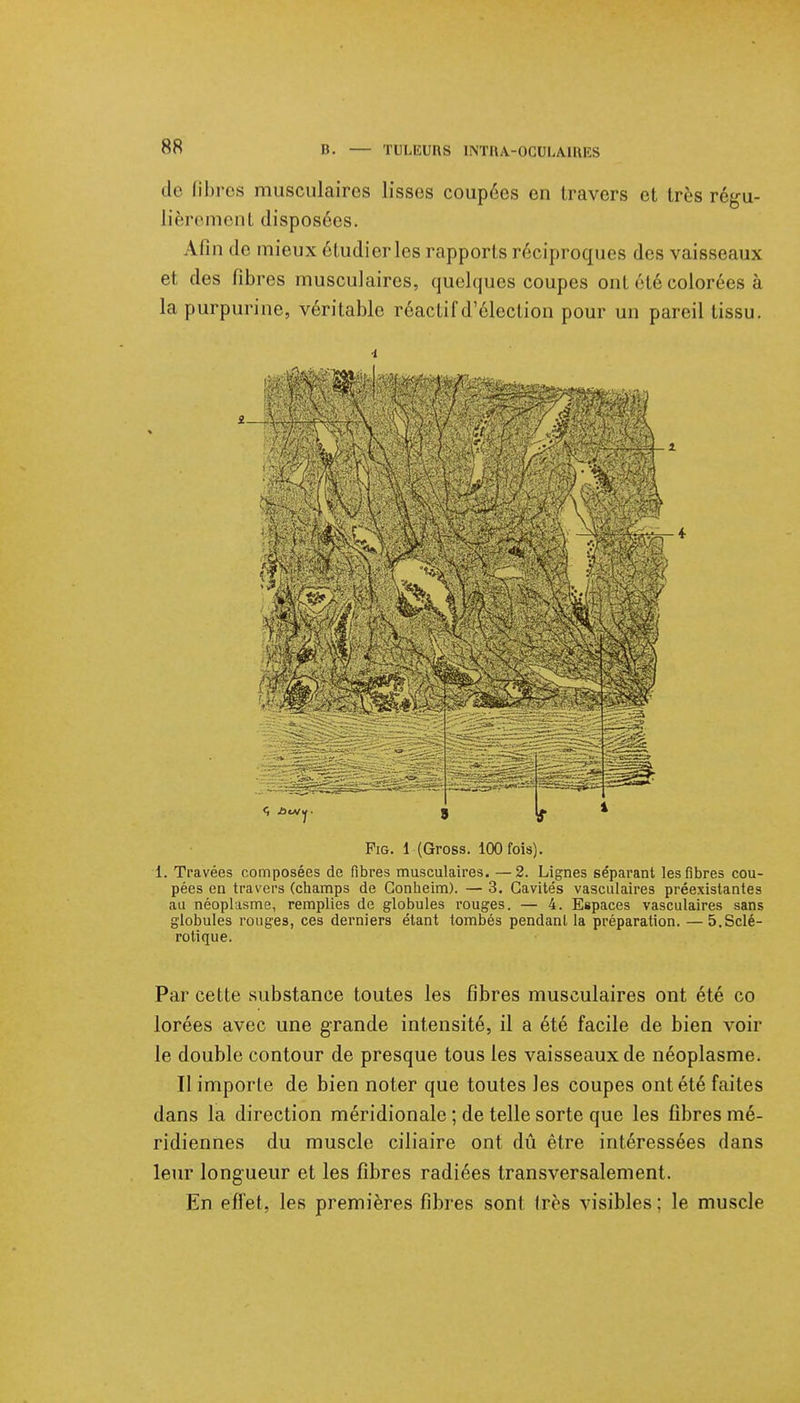 B. — TULËURS 1NTHA-0CUIA1HKS de libres musculaires lisses coupées en travers et très régu- lièrement disposées. Alin de mieux étudier les rapports réciproques des vaisseaux et des fibres musculaires, quelques coupes ont été colorées à la purpurine, véritable réactif d'élection pour un pareil tissu. 9 Fis. 1 (Gross. 100 fois). 1. Travées composées de fibres musculaires. —2. Lignes séparant les fibres cou- pées en travers (champs de Gonheim). — 3. Cavités vasculaires préexistantes au néoplasme, remplies de globules rouges. — 4. Espaces vasculaires sans globules rouges, ces derniers étant tombés pendant la préparation. — 5.Sclé- rotique. Par cette substance toutes les fibres musculaires ont été co lorées avec une grande intensité, il a été facile de bien voir le double contour de presque tous les vaisseaux de néoplasme. Il importe de bien noter que toutes les coupes ont été faites dans la direction méridionale ; de telle sorte que les fibres mé- ridiennes du muscle ciliaire ont dû être intéressées dans leur longueur et les fibres radiées transversalement. En effet, les premières fibres sont frès visibles; le muscle
