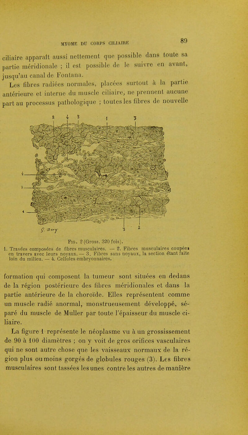 80 ciliaire apparaît aussi nettement que possible dans toute sa partie méridionale ; il est possible de Le suivre en avant, jusqu'au canal de Fontana. Les fibres radiées normales, placées surfont à la partie antérieure et interne «lu muscle ciliaire, ne prennent aucune part au processus pathologique ; toutes les fibres de nouvelle Fig. 2(Gross. 320 fois). i. Travées composées de fibres musculaires. — 2. Fibres musculaires coupées en travers avec leurs noyaux. — 3. Fibres sans noyaux, la section étant faite loin du milieu. — 4. Cellules embryonnaires. formation qui composent la tumeur sont situées en dedans de la région postérieure des fibres méridionales et dans la partie antérieure de la choroïde. Elles représentent comme un muscle radié anormal, monstrueusement développé, sé- paré du muscle de Muller par toute l'épaisseur du muscle ci- liaire. La figure 1 représente le néoplasme vu à un grossissement de 90 à 100 diamètres ; on y voit de gros orifices vasculaires qui ne sont autre chose que les vaisseaux normaux de la ré- gion plus ou moins gorgés de globules rouges (3). Les fibres musculaires sont tassées les unes contre les autres de manière