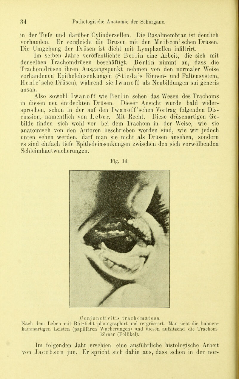 in der Tiefe und darüber Cylinderzellen. Die Basalmembran ist deutlich vorhanden. Er vergleicht die Drüsen mit den Meibom'sehen Drüsen. Die Umgebung der Drüsen ist dicht mit Lymphzellen infiltrirt. Im selben Jahre veröffentlichte Berlin eine Arbeit, die sich mit denselben Trachomdrüsen beschäftigt. Berlin nimmt an, dass die Trachomdrüsen ihren Ausgangspunkt nehmen von den normaler Weise vorhandenen Epitheleinsenkungen (Stieda's Rinnen- und Falten System, Henle'sche Drüsen), während sie Iwan off als Neubildungen sui generis ansah. Also sowohl Iwanoff wie Berlin sehen das Wesen des Trachoms in diesen neu entdeckten Drüsen. Dieser Ansicht wurde bald wider- sprochen, schon in der auf den Iwanoff'sehen Vortrag folgenden Dis- cussion, namentlich von Leber. Mit Recht. Diese drüsenartigen Ge- bilde finden sich wohl vor bei dem Trachom in der Weise, wie sie anatomisch von den Autoren beschrieben worden sind, wie wir jedoch unten sehen werden, darf man sie nicht als Drüsen ansehen, sondern es sind einfach tiefe Epitheleinsenkungen zwischen den sich vorwölbenden Schleimhautwucherungen. Conjunctivitis trachomatosa. Nach dem Leben mit Blitzlicht photographirt und vergrössert. Man sieht die hahnen- kammartigen Leisten (papillären Wucherungen) und diesen aufsitzend die Trachom- körner (Follikel). Im folgenden Jahr erschien eine ausführliche histologische Arbeit von Jacobson jun. Er spricht sich dahin aus, dass schon in der nor- Fig. 14.