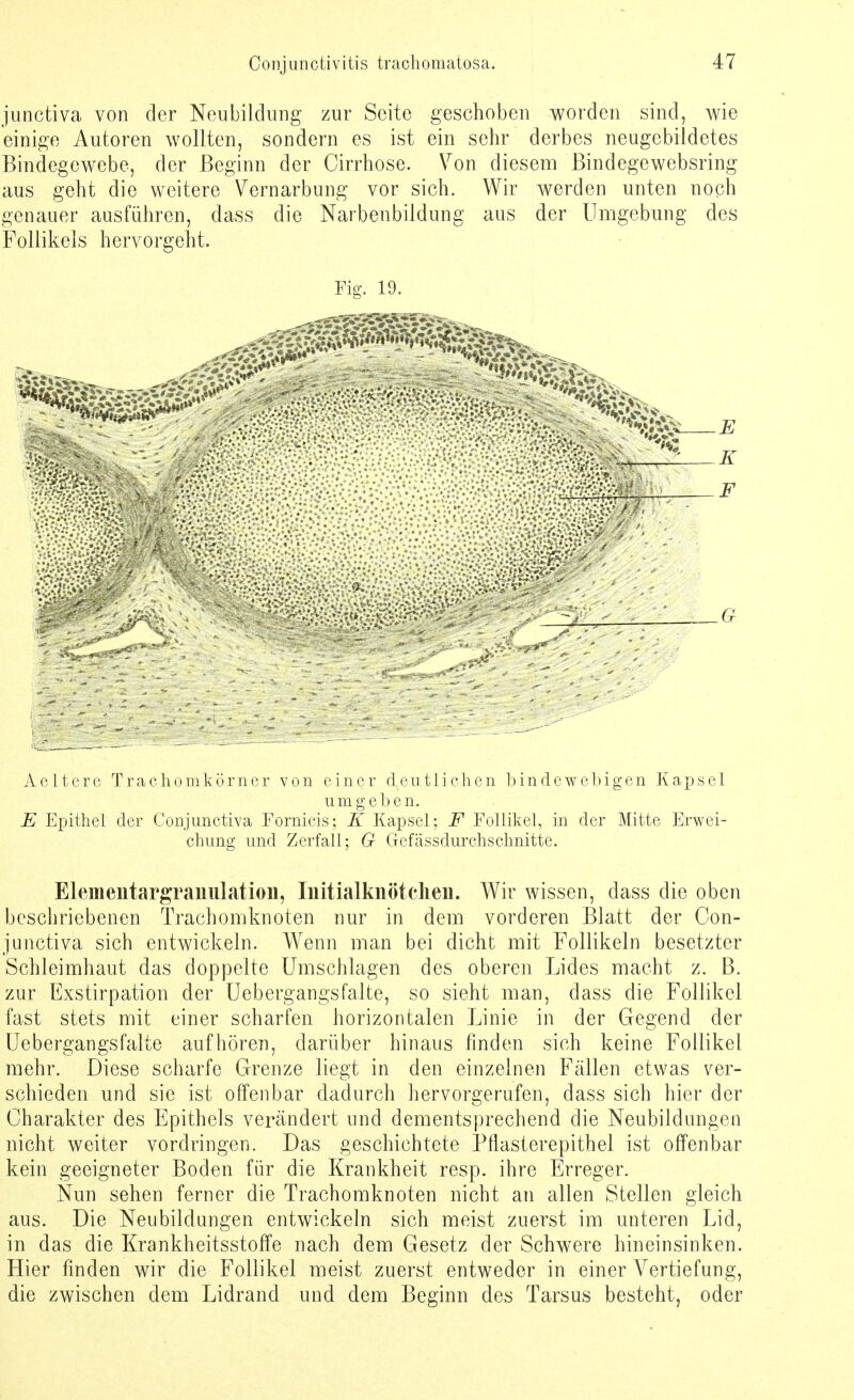 junctiva von der Neubildung zur Seite geschoben worden sind, wie einige Autoren wollten, sondern es ist ein sehr derbes neugebildetes Bindegewebe, der Beginn der Cirrhose. Von diesem Bindegewebsring aus geht die weitere Vernarbung vor sich. Wir werden unten noch genauer ausführen, dass die Narbenbildung aus der Umgebung des Follikels hervorgeht. Fig. 19. ■ --' , ...... ' ••/•.v., - —lj Aeltere Trachomkörner von einer deutlichen bindewebigen Kapsel umgeben. E Epithel der Conjunctiva Fornicis; K Kapsel; F Follikel, in der Mitte Erwei- chung und Zerfall; G Gefässdurchschnitte. Elementargranulation, Initialknötchen. Wir wissen, dass die oben beschriebenen Trachomknoten nur in dem vorderen Blatt der Con- junctiva sich entwickeln. Wenn man bei dicht mit Follikeln besetzter Schleimhaut das doppelte Umschlagen des oberen Lides macht z. B. zur Exstirpation der Uebergangsfalte, so sieht man, dass die Follikel fast stets mit einer scharfen horizontalen Linie in der Gegend der Uebergangsfalte aufhören, darüber hinaus finden sich keine Follikel mehr. Diese scharfe Grenze liegt in den einzelnen Fällen etwas ver- schieden und sie ist offenbar dadurch hervorgerufen, dass sich hier der Charakter des Epithels verändert und dementsprechend die Neubildungen nicht weiter vordringen. Das geschichtete Pflasterepithel ist offenbar kein geeigneter Boden für die Krankheit resp. ihre Erreger. Nun sehen ferner die Trachomknoten nicht an allen Stellen gleich aus. Die Neubildungen entwickeln sich meist zuerst im unteren Lid, in das die Krankheitsstoffe nach dem Gesetz der Schwere hineinsinken. Hier finden wir die Follikel meist zuerst entweder in einer Vertiefung, die zwischen dem Lidrand und dem Beginn des Tarsus besteht, oder