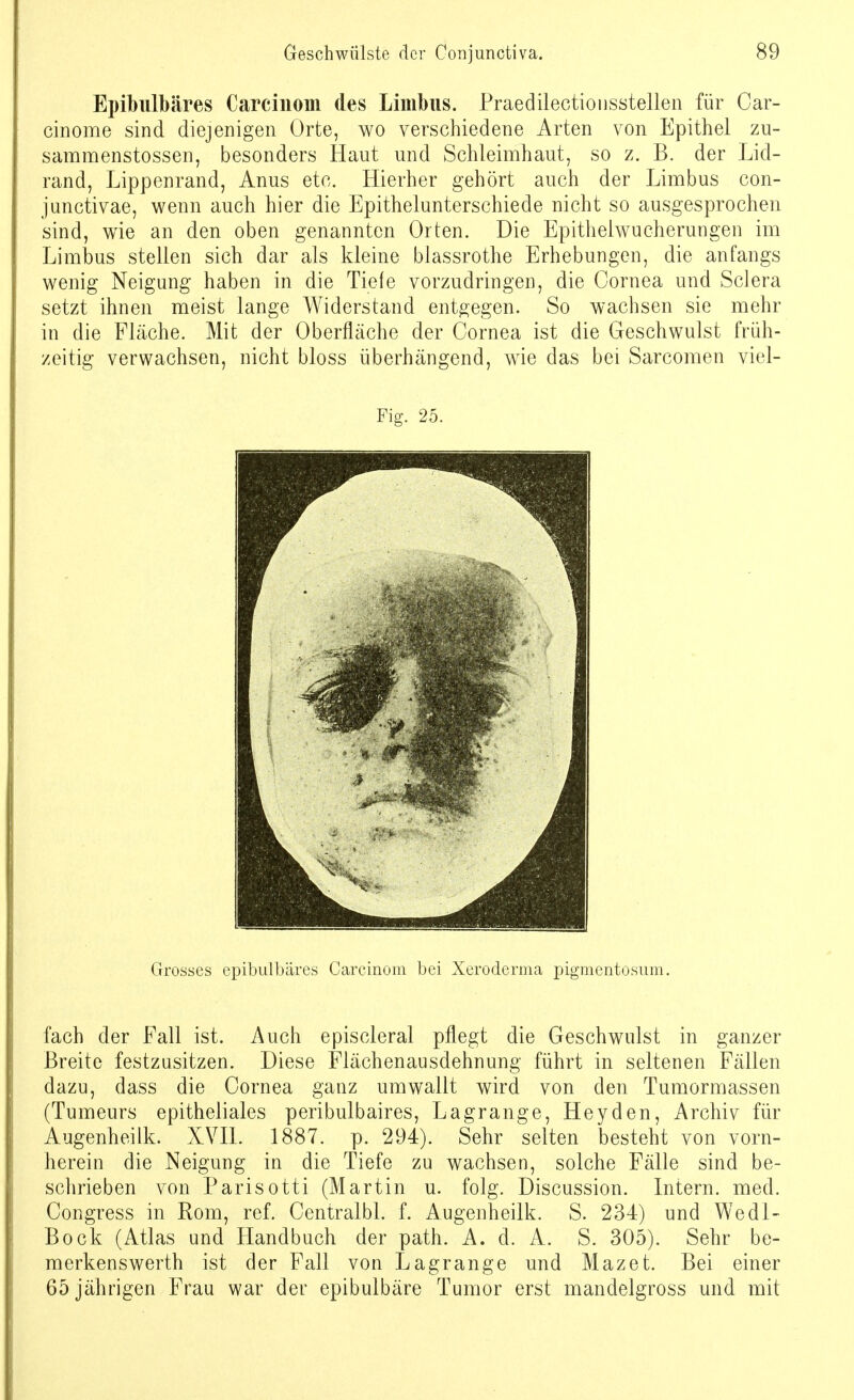 Epibulbäres Carcinom des Linibus. Praedilectionsstellen für Car- cinome sind diejenigen Orte, wo verschiedene Arten von Epithel zu- sammenstossen, besonders Haut und Schleimhaut, so z. B. der Lid- rand, Lippenrand, Anus etc. Hierher gehört auch der Limbus con- junctivae, wenn auch hier die Epithelunterschiede nicht so ausgesprochen sind, wie an den oben genannten Orten. Die Epithelwucherungen im Limbus stellen sich dar als kleine blassrothe Erhebungen, die anfangs wenig Neigung haben in die Tiefe vorzudringen, die Cornea und Sclera setzt ihnen meist lange Widerstand entgegen. So wachsen sie mehr in die Fläche. Mit der Oberfläche der Cornea ist die Geschwulst früh- zeitig verwachsen, nicht bloss überhängend, wie das bei Sarcomen viel- Fig. 25. Grosses epibulbäres Carcinom bei Xeroderma pigmentosum. fach der Fall ist. Auch episcleral pflegt die Geschwulst in ganzer Breite festzusitzen. Diese Flächenausdehnung führt in seltenen Fällen dazu, dass die Cornea ganz umwallt wird von den Tumormassen (Tumeurs epitheliales peribulbaires, Lagrange, Heyden, Archiv für Augenheilk. XVII. 1887. p. 294). Sehr 'selten besteht von vorn- herein die Neigung in die Tiefe zu wachsen, solche Fälle sind be- schrieben von Parisotti (Martin u. folg. Discussion. Intern, med. Congress in Rom, ref. Centralbl. f. Augenheilk. S. 234) und Wedl- Bock (Atlas und Handbuch der path. A. d. A. S. 305). Sehr be- merkenswert!] ist der Fall von Lagrange und Mazet. Bei einer 65 jährigen Frau war der epibulbäre Tumor erst mandelgross und mit