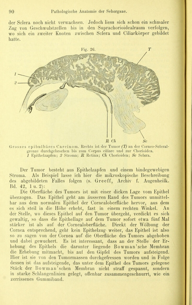 der Sclera noch nicht verwachsen. Jedoch liess sich schon ein schmaler Zug von Geschwulstzellen bis in den Suprachorioidealraum verfolgen, wo sich ein zweiter Knoten zwischen Sclera und Ciliarkörper gebildet hatte. Fig. 26. T R Ch Sc Grosses epibulbäres Carcinom. Rechts ist der Tumor (T) an der Cornco-Scleral- grenze durchgehrochen bis zum Corpus ciliare und zur Chorioidea. 1 Epithelzapfen; 2 Stroma; B Retina; Ch Chorioidea; Sc Sclera. Der Tumor besteht aus Epithelzapfen und einem bindegewebigen Stroma. Als Beispiel lasse ich hier die mikroskopische Beschreibung des abgebildeten Falles folgen (s. Greeff, Archiv f. Augenheilk. Bd. 42, lu. 2): Die Oberfläche des Tumors ist mit einer dicken Lage vom Epithel überzogen. Das Epithel geht am äusseren Rand des Tumors unmittel- bar aus dem normalen Epithel der Cornealoberfläche hervor, aus dem es sich steil in die Höhe erhebt, fast in einem rechten Winkel. An der Stelle, wo dieses Epithel auf den Tumor übergeht, verdickt es sich gewaltig, so dass die Epithellage auf dem Tumor sofort etwa fünf Mal stärker ist als auf der Cornealoberfläche. Direkt der Wölbung der Cornea entsprechend, geht kein Epithelzug weiter, das Epithel ist also so zu sagen von der Cornea auf die Oberfläche des Tumors abgehoben und dabei gewuchert. Es ist interessant, dass an der Stelle der Er- hebung des Epithels die darunter liegende Bowman'sche Membran die Erhebung mitmacht, bis auf den Gipfel des Tumors aufsteigend. Hier ist sie von den Tumormassen durchgefressen worden und in Folge dessen ist das aufsteigende, das unter dem Epithel des Tumors gelegene Stück der Bowm an'sehen Membran nicht straff gespannt, sondern in starke Schlangenlinien gelegt, offenbar zusammengeschnurrt, wie ein zerrissenes Gummiband.