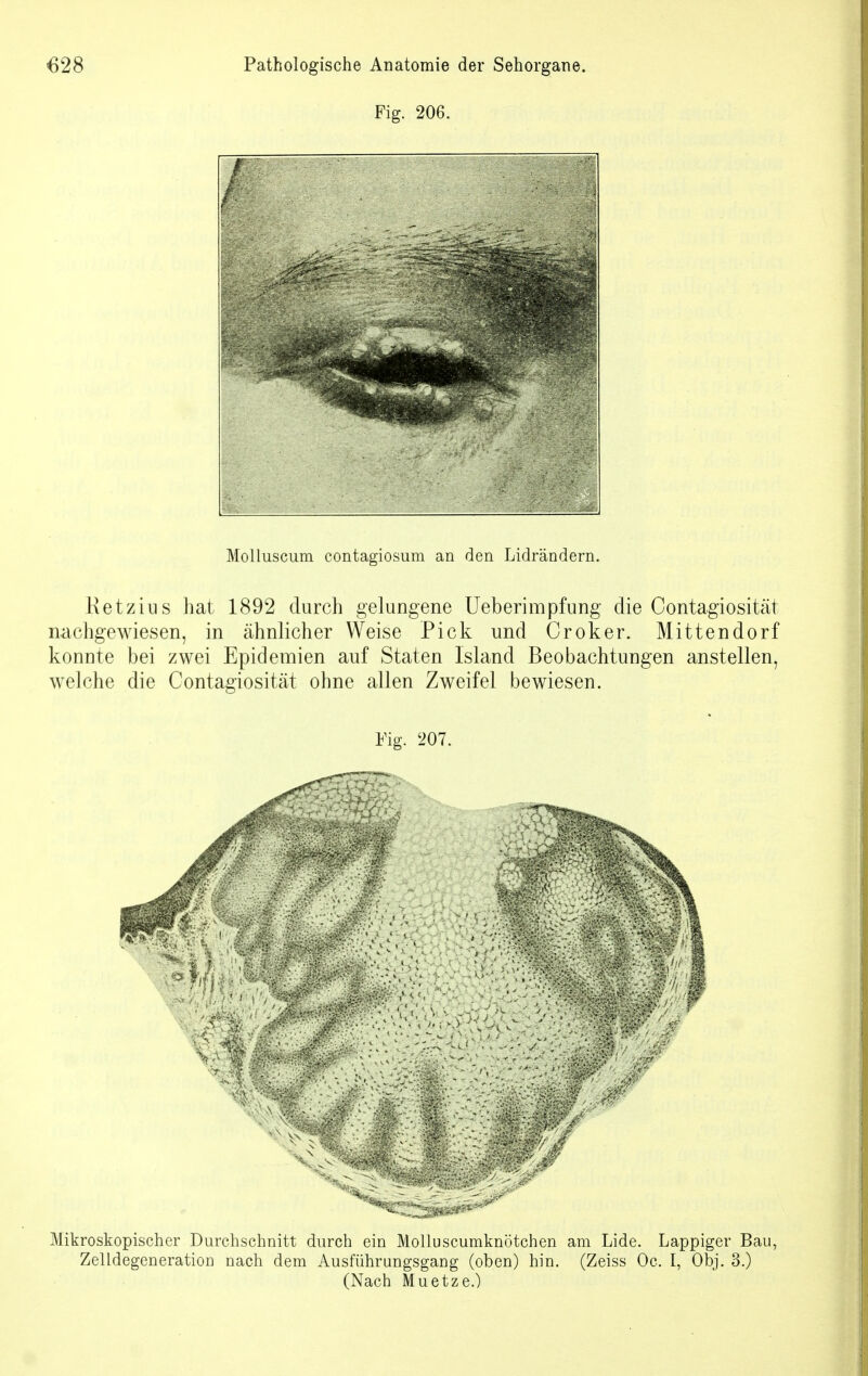 Fig. 206. Molluscum contagiosum an den Lidrändern. Ketzins hat 1892 durch gelungene Ueberimpfung die Contagiosität nachgewiesen, in ähnlicher Weise Pick und Croker. Mittendorf konnte bei zwei Epidemien auf Staten Island Beobachtungen anstellen, welche die Contagiosität ohne allen Zweifel bewiesen. Fig. 207. Mikroskopischer Durchschnitt durch ein Molluscumknötchen am Lide. Lappiger Bau, Zelldegeneration nach dem Ausführungsgang (oben) hin. (Zeiss Oc. I, Obj. 3.) (Nach Muetze.)