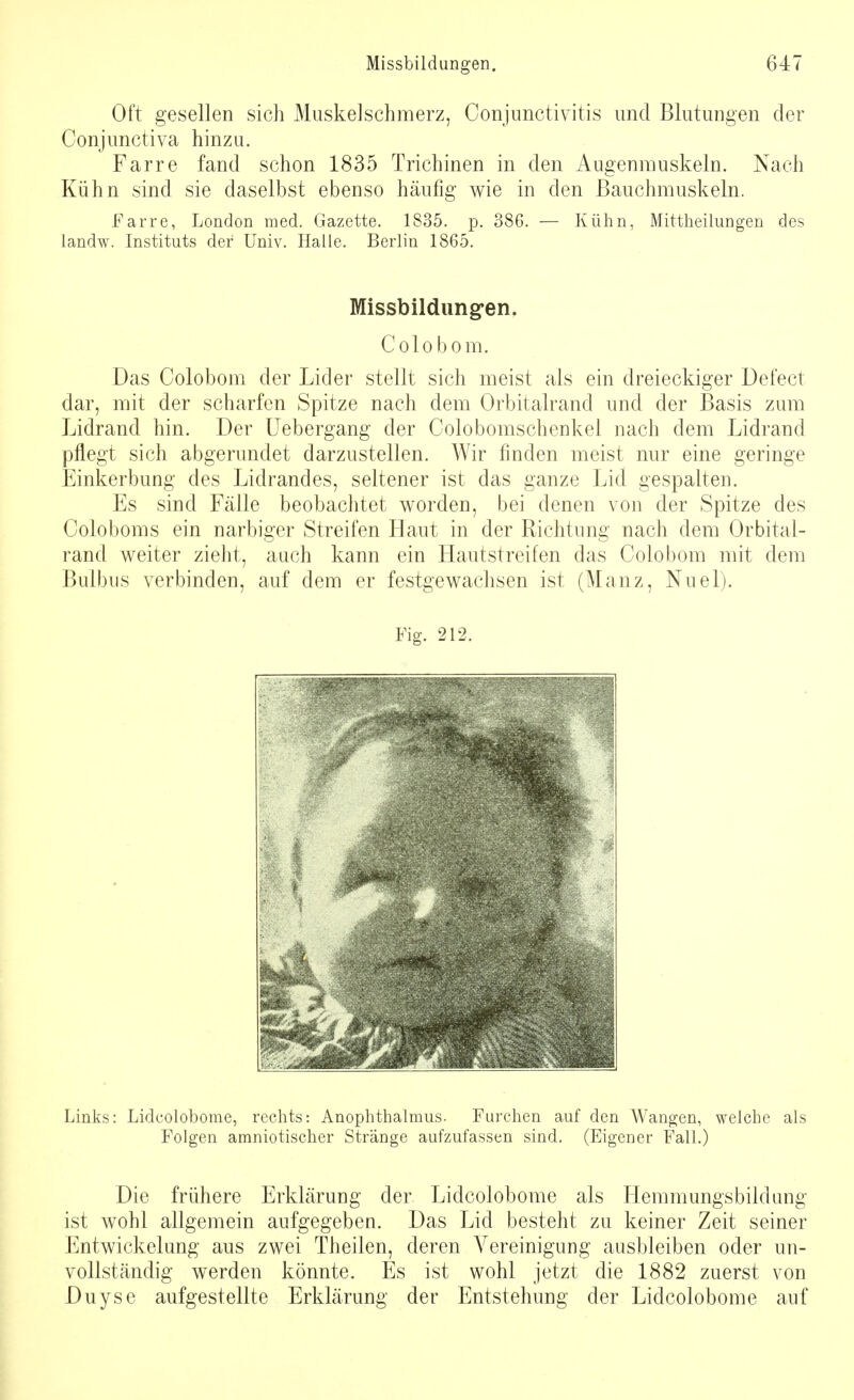 Oft gesellen sich Muskelschmerz, Conjunctivitis und Blutungen der Conjunctiva hinzu. Farre fand schon 1835 Trichinen in den Augenmuskeln. Nach Kühn sind sie daselbst ebenso häufig wie in den Bauchmuskeln. Farre, London med. Gazette. 1835. p. 386. — Kühn, Mittheilungen des landw. Instituts der Univ. Halle. Berlin 1865. Missbildungen. Colobom. Das Colobom der Lider stellt sich meist als ein dreieckiger Defect dar, mit der scharfen Spitze nach dem Orbitalrand und der Basis zum Lidrand hin. Der Uebergang der Colobomschenkel nach dem Lidrand pflegt sich abgerundet darzustellen. Wir finden meist nur eine geringe Einkerbung des Lidrandes, seltener ist das ganze Lid gespalten. Es sind Fälle beobachtet worden, bei denen von der Spitze des Coloboms ein narbiger Streifen Haut in der Richtung nach dem Orbital- rand weiter zieht, auch kann ein Hautstreifen das Colobom mit dem Bulbus verbinden, auf dem er festgewachsen ist (Manz, Nuel). Fig. 212. Links: Lidcolobome, rechts: Anophthalmus. Furchen auf den Wangen, welche als Folgen amniotischer Stränge aufzufassen sind. (Eigener Fall.) Die frühere Erklärung der Lidcolobome als Hemmungsbildung ist wohl allgemein aufgegeben. Das Lid besteht zu keiner Zeit seiner Entwicklung aus zwei Theilen, deren Vereinigung ausbleiben oder un- vollständig werden könnte. Es ist wohl jetzt die 1882 zuerst von Duyse aufgestellte Erklärung der Entstehung der Lidcolobome auf