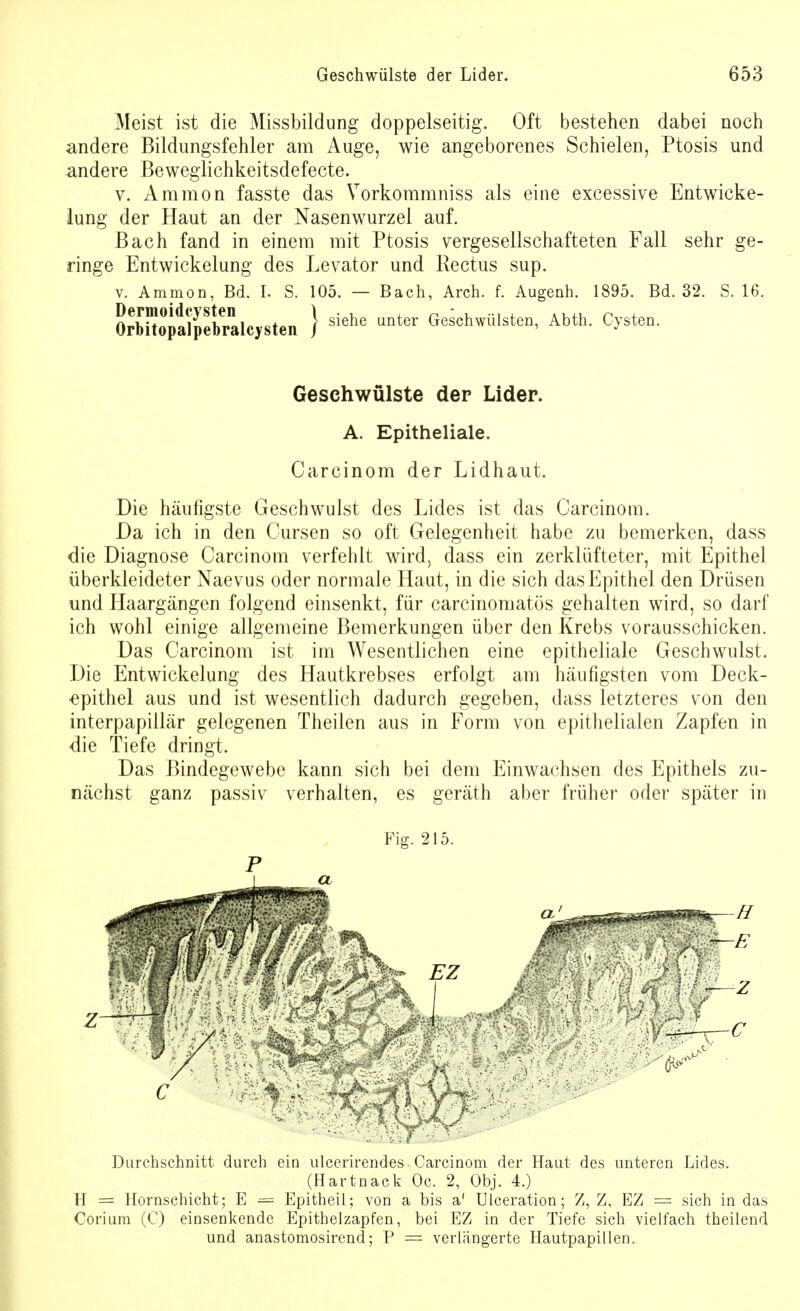 Meist ist die Missbildung doppelseitig. Oft bestehen dabei noch andere Bildungsfehler am Auge, wie angeborenes Schielen, Ptosis und andere Beweglichkeitsdefecte. v. Amnion fasste das Vorkommniss als eine excessive Entwicke- lung der Haut an der Nasenwurzel auf. Bach fand in einem mit Ptosis vergesellschafteten Fall sehr ge- ringe Entwickelung des Levator und Rectus sup. v. Ammon, Bd. I. S. 105. — Bach, Arch. f. Augenh. 1895. Bd. 32. S. 16. &Äfb7alcysten } siehe ^ ^schwülsten, Abth. Cysten. Geschwülste der Lider. A. Epitheliale. Carcinom der Lidhaut. Die häufigste Geschwulst des Lides ist das Carcinom. Da ich in den Cursen so oft Gelegenheit habe zu bemerken, dass die Diagnose Carcinom verfehlt wird, dass ein zerklüfteter, mit Epithel überkleideter Naevus oder normale Haut, in die sich das Epithel den Drüsen und Haargängen folgend einsenkt, für carcinomatös gehalten wird, so darf ich wohl einige allgemeine Bemerkungen über den Krebs vorausschicken. Das Carcinom ist im Wesentlichen eine epitheliale Geschwulst. Die Entwickelung des Hautkrebses erfolgt am häufigsten vom Deck- epithel aus und ist wesentlich dadurch gegeben, dass letzteres von den interpapillär gelegenen Theilen aus in Form von epithelialen Zapfen in die Tiefe dringt. Das Bindegewebe kann sich bei dem Einwachsen des Epithels zu- nächst ganz passiv verhalten, es geräth aber früher oder später in Fig. 215. P Durchschnitt durch ein ulcerirendes Carcinom der Haut des unteren Lides. (Hartnack Oc, 2, Obj. 4.) FI = Hornschicht; E — Epitheil; von a bis a' Ulceration; Z, Z, EZ = sich in das Corium (C) einsenkende Epithelzapfen, bei EZ in der Tiefe sich vielfach theilend und anastomosirend; P = verlängerte Hautpapillen.