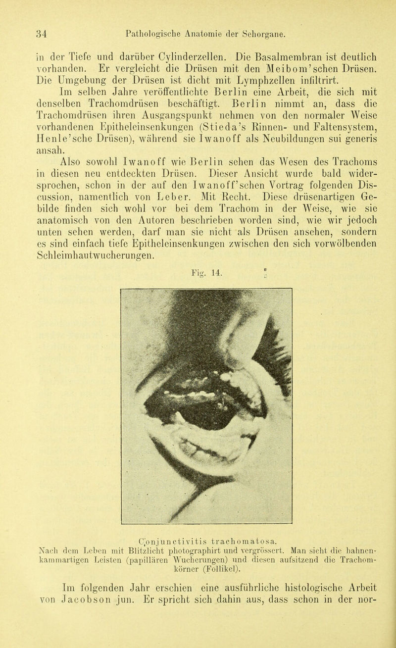 in der Tiefe und darüber Cylinderzellen. Die Basalmembran ist deutlich vorhanden. Er vergleicht die Drüsen mit den Meibom'sehen Drüsen. Die Umgebung der Drüsen ist dicht mit Lymphzellen inflltrirt. Im selben Jahre veröffentlichte Berlin eine Arbeit, die sich mit denselben Trachomdrüsen beschäftigt. Berlin nimmt an, dass die Trachomdrüsen ihren Ausgangspunkt nehmen von den normaler Weise vorhandenen Epitheleinsenkungen (Stieda's Rinnen- und Falten System, He nie'sehe Drüsen), Wcährend sie Iwan off als Neubildungen sui generis ansah. Also sowohl Iwanoff wie Berlin sehen das Wesen des Trachoms in diesen neu entdeckten Drüsen. Dieser Ansicht wurde bald wider- sprochen, schon in der auf den Iwanoff'sehen Vortrag folgenden Dis- cussion, namentlich von Leber. Mit Recht. Diese drüsenartigen Ge- bilde finden sich wohl vor bei dem Trachom in der Weise, wie sie anatomisch von den Autoren beschrieben worden sind, wie wir jedoch unten sehen werden, darf man sie nicht als Drüsen ansehen, sondern es sind einfach tiefe Epitheleinsenkungen zwischen den sich vorwölbenden Schleimhautwucherungen. Fig. 14. l 0^0 nj u n c t i V i t i s t r a c h o m a t o s a. Nach dem Leben mit Blitzlicht photographirt und vergrössert. Man sieht die hahnen- karamartigen Leisten (papillären Wucherungen) und diesen aufsitzend die Trachom- körner (Follikel). Im folgenden Jahr erschien eine ausführliche histologische Arbeit von Jacobson jun. Er spricht sich dahin aus, dass schon in der nor-