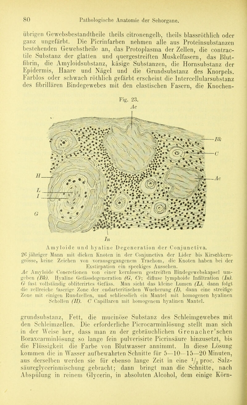 übrigeil Gewebsbestandtheile theils citroneiigelb, theils blassröthlich oder ganz ungefärbt. Die Picrinfarben nehmen alle aus Proteinsubstanzen bestehenden Gewebstheile an, das Protoplasma der Zellen, die contrac- tile Substanz der glatten und quergestreiften Muskelfasern, das Blut- fibrin, die Amyloidsubstanz, käsige Substanzen, die Hornsubstanz der Epidermis, Haare und Nägel und die Grundsubstanz des Knorpels. Farblos oder schwach röthlich gefärbt erscheint die Intercellularsubstanz des fibrillären Bindegewebes mit den elastischen Fasern, die Knochen- Fig. 23. Ac # 9 Amyloide und hyaline Degeneration der Conjunctiva. 26 jähriger Mann mit dicken Knoten in der Conjunctiva der Lider bis Kirschkern- grösse, keine Zeichen von vorausgegangenem Trachom, die Knoten haben bei der Exstirpation ein speckiges Aussehen. Ac Amyloide Concretionen von einer kernlosen gestreiften Bindegewebskapsel um- geben (Bk). Hyaline Gelässdegeneration (G, C); diffuse lymphoide Infiltration (In). G fast vollständig obliterirtes Gefäss. Man sieht das kleine Lumen (L), dann folgt die zellreiche faserige Zone der endarteritischen Wucherung (I), dann eine streifige Zone mit einigen Eundzellen, und schliesslich ein Mantel mit homogenen hyalinen Schollen (H). C Capillaren mit homogenem hyalinen Mantel. grundsubstanz, Fett, die mucinöse Substanz des SchJeimgewebes mit den Schleimzellen. Die erforderliche Picrocarminlösung stellt man sich in der Weise her, dass man zu der gebräuchlichen Gren ach er'sehen Boraxcarminlösung so lange fein pulverisirte Picrinsäure hinzusetzt, bis die Flüssigkeit die Farbe von Blutwasser annimmt. In diese Lösung kommen die in Wasser aufbewahrten Schnitte für 5—10—15—20 Minuten, aus derselben werden sie für ebenso lange Zeit in eine Y2 V^^^- Salz- säureglycerinmischung gebracht; dann bringt man die Schnitte, nach Abspülung in reinem Glycerin, in absoluten Alcohol, dem einige Körn-