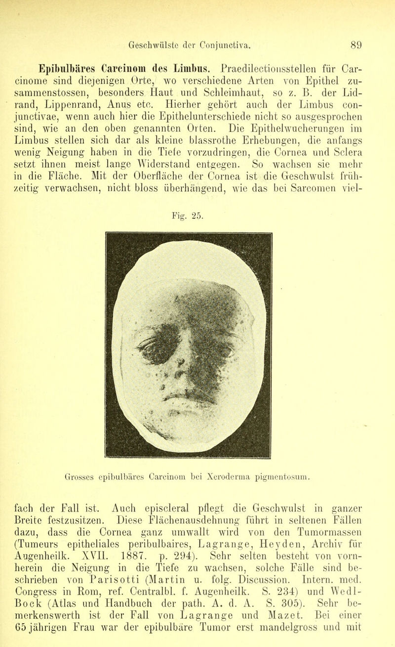 Epibulbäres Carciiiom des Limbus. Praedilectiousstellen für Car- cinome sind diejenigen Orte, wo verschiedene Arten von Epithel zu- sammenstossen, besonders Haut und Schleimhaut, so z. B. der Lid- rand, Lippenrand, Anus etc. Hierher gehört auch der Limbus con- junctivae, wenn auch hier die Epithelunterschiede nicht so ausgesprochen sind, wie an den oben genannten Orten. Die Epithelwucherungen im Limbus stellen sich dar als kleine blassrothe Erhebungen, die anfangs wenig Neigung haben in die Tiefe vorzudringen, die Cornea und Sclera setzt ihnen meist lange Widerstand entgegen. So wachsen sie mehr in die Fläche. Mit der Oberfläche der Cornea ist die Geschwulst früh- zeitig verwachsen, nicht bloss überhängend, wie das bei Sarcomen viel- Fig. 25. Grosses epibulbäres Carcinoni bei Xeroderma pigmentosum. fach der Fall ist. Auch episcleral pflegt die Geschwulst in ganzer Breite festzusitzen. Diese Flächenausdehnung führt in seltenen Fällen dazu, dass die Cornea ganz umwallt wird von den Tumormassen (Tumeurs epitheliales peribulbaires, Lagrange, Heyden, Archiv für Augenheilk. XVH. 1887. p. 294). Sehr selten besteht von vorn- herein die Neigung in die Tiefe zu wachsen, solche Fälle sind be- schrieben von Parisotti (Martin u. folg. Discussion. Intern, med. Congress in Rom, ref. Centralbl. f. Augenheilk. S. 234) und Wedl- Bock (Atlas und Handbuch der path. A. d. A. S. 305). Sehr be- merkenswerth ist der Fall von Lagrange und Mazet. Bei einer 65 jährigen Frau war der epibulbäre Tumor erst mandelgross und mit