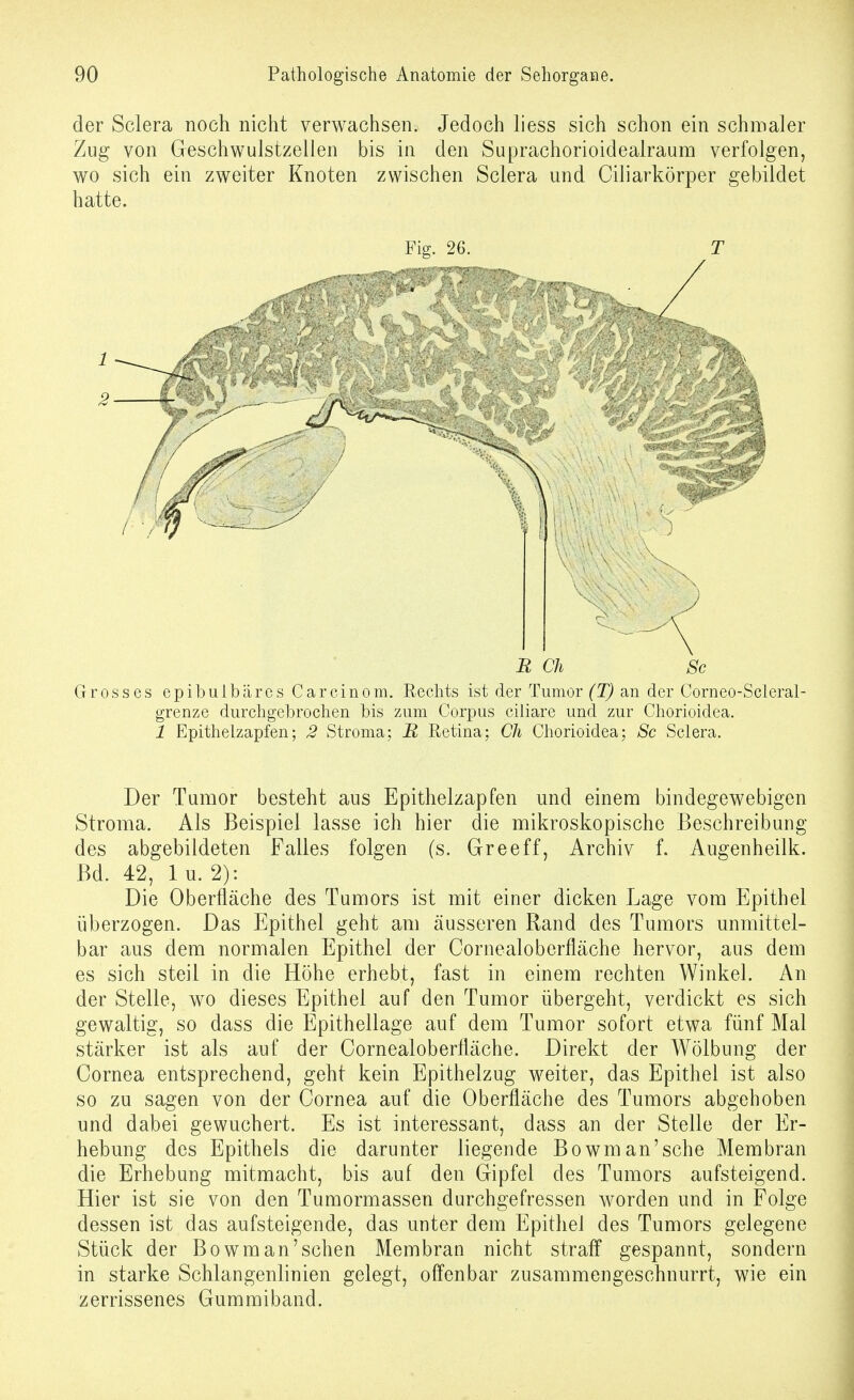 der Sclera noch nicht verwachsen. Jedoch liess sich schon ein schmaler Zug von Geschwulstzelien bis in den Suprachorioidealraum verfolgen, wo sich ein zweiter Knoten zwischen Sclera und Ciliarkörper gebildet hatte. Fio-, 26. T n ch Sc Grosses epibuibäresCarcinom. Rechts ist der Tumor (T) an der Corneo-Scleral- grenze durchgebrochen bis zum Corpus ciliare und zur Chorioidea. 1 Epithelzapfen; 2 Stroma; Retina; Ch Chorioidea; Sc Sclera. Der Tumor besteht aus Epithelzapfen und einem bindegewebigen Stroma. Als Beispiel lasse ich hier die mikroskopische Beschreibung des abgebildeten Falles folgen (s. Greeff, Archiv f. Augenheilk. Bd. 42, lu. 2): Die Oberfläche des Tumors ist mit einer dicken Lage vom Epithel überzogen. Das Epithel geht am äusseren Rand des Tumors unmittel- bar aus dem normalen Epithel der Cornealoberfläche hervor, aus dem es sich steil in die Höhe erhebt, fast in einem rechten Winkel. An der Stelle, wo dieses Epithel auf den Tumor übergeht, verdickt es sich gewaltig, so dass die Epithellage auf dem Tumor sofort etwa fünf Mal stärker ist als auf der Cornealoberfläche. Direkt der Wölbung der Cornea entsprechend, geht kein Epithelzug weiter, das Epithel ist also so zu sagen von der Cornea auf die Oberfläche des Tumors abgehoben und dabei gewuchert. Es ist interessant, dass an der Stelle der Er- hebung des Epithels die darunter liegende Bowman'sche Membran die Erhebung mitmacht, bis auf den Gipfel des Tumors aufsteigend. Hier ist sie von den Tumormassen durchgefressen worden und in Folge dessen ist das aufsteigende, das unter dem Epithel des Tumors gelegene Stück der Bowm an'sehen Membran nicht straff gespannt, sondern in starke Schlangenlinien gelegt, offenbar zusammengeschnurrt, wie ein zerrissenes Gummiband.